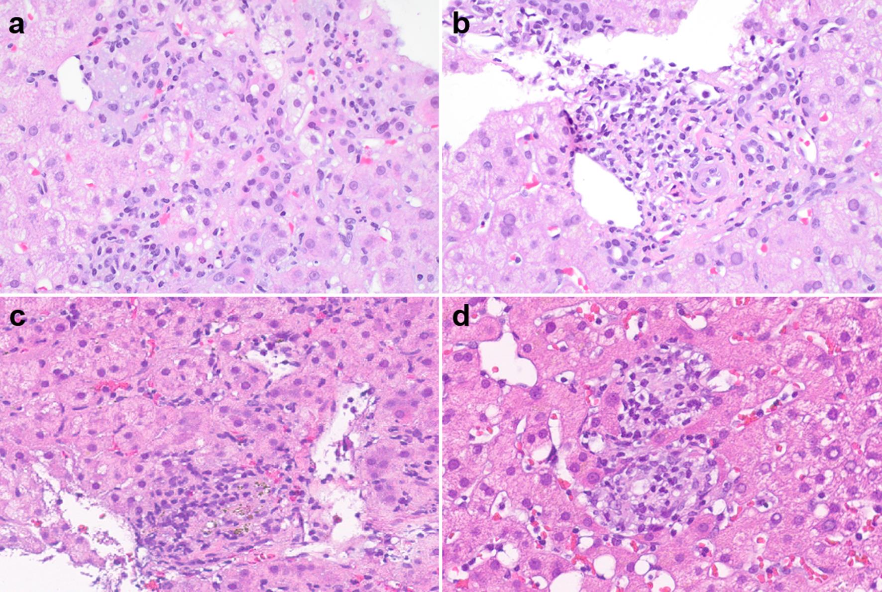 Immune checkpoint inhibitor-induced liver injury, hepatitic pattern.