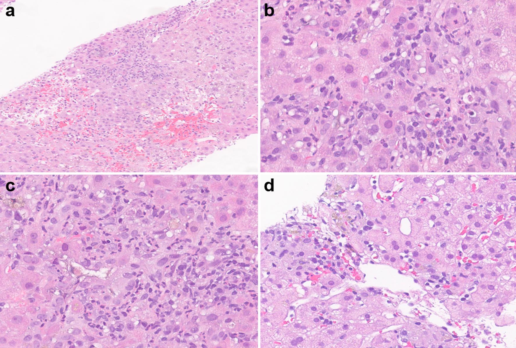 Immune checkpoint inhibitor-induced liver injury, mixed hepatitic and cholangitic pattern.