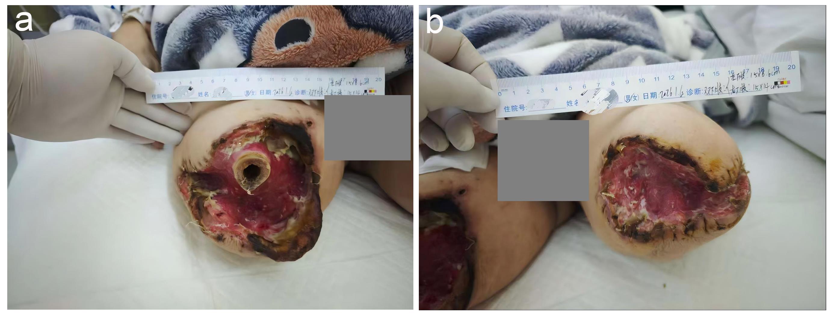 Baseline appearance of the bilateral above-knee amputation stump ulcers at admission.
