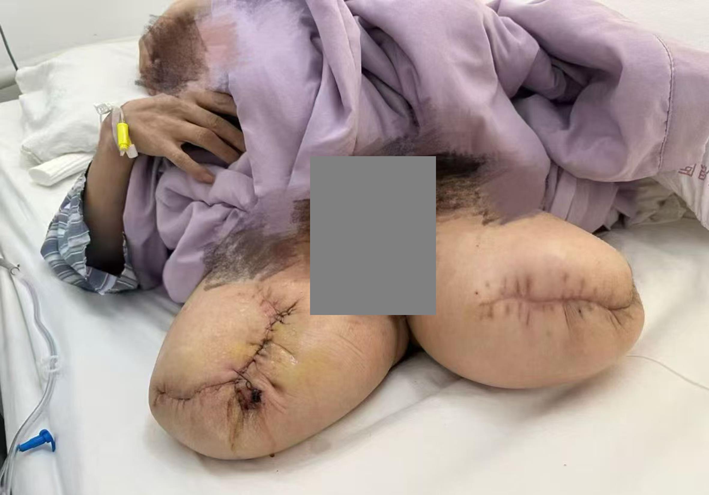 Wound condition after staged stump repair and closure.
