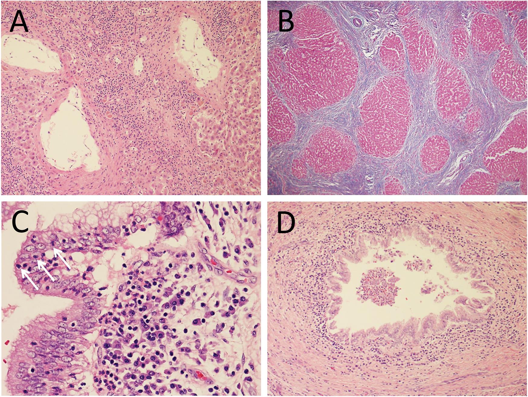 (A) Portal tract with preserved vascular structures, without accompanying bile duct, consistent with the patient’s diagnosis of PSC; H&E stain, 100×. (B) Trichrome stain highlights cirrhotic liver parenchyma; MT stain, 100×. (C) Bile duct with numerous intraepithelial neutrophils (arrows); H&E stain, 400×. (D) Large bile duct with intraluminal collections of neutrophils; H&E stain, 100×.