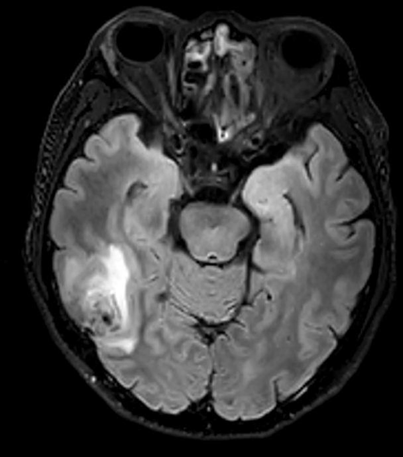The patient’s preoperative magnetic resonance imaging examination showed a mass in the right temporal occipital lobe.