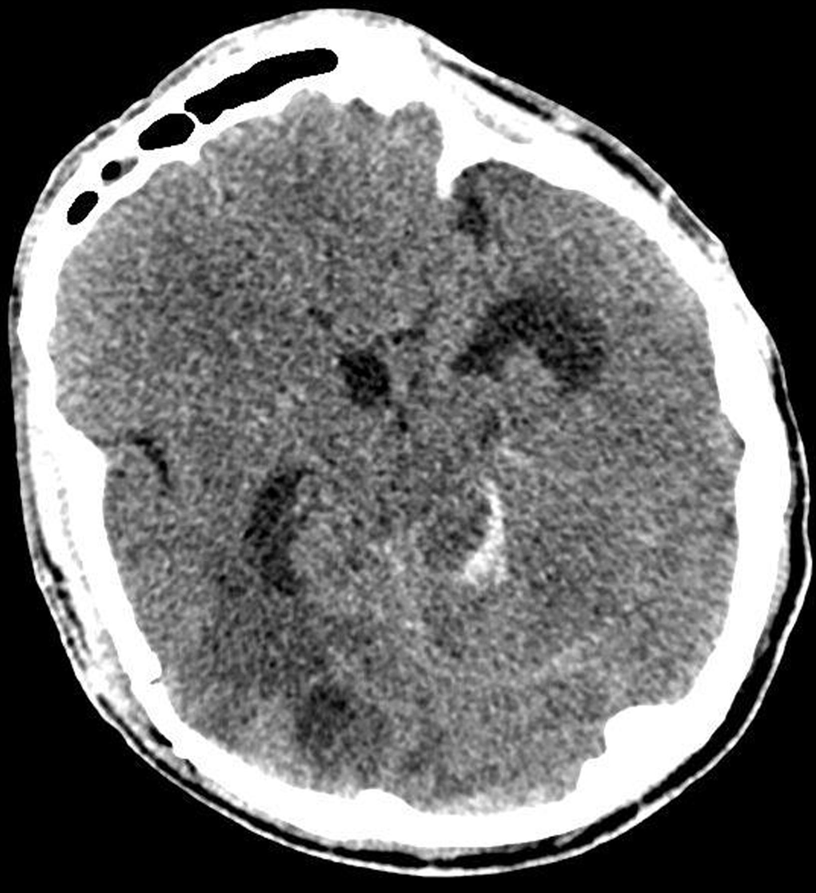 The patient’s postoperative computed tomography scan showed edema in the right temporal and occipital lobe brain tissue, along with intraventricular hemorrhage.