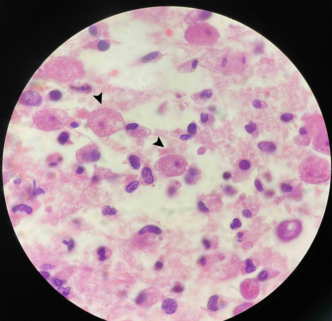 Pathogenic free-living amoebas were found in the surgically removed tissue of the patient (Oil immersion lens, 1,500×).