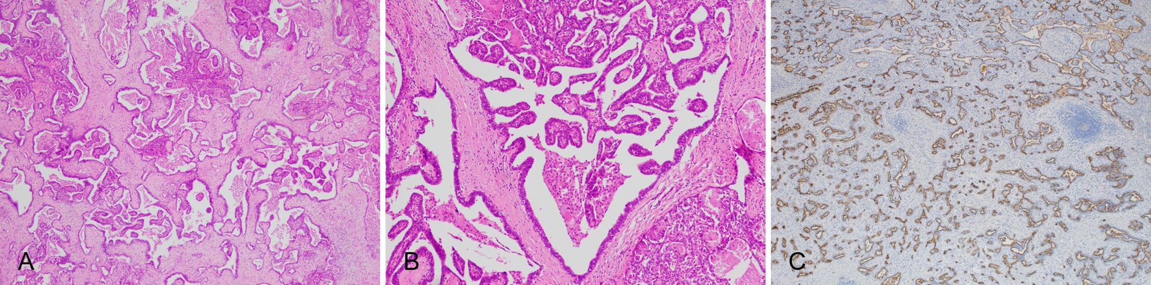 Expert Consensus On Pathological Diagnosis Of Intrahepatic