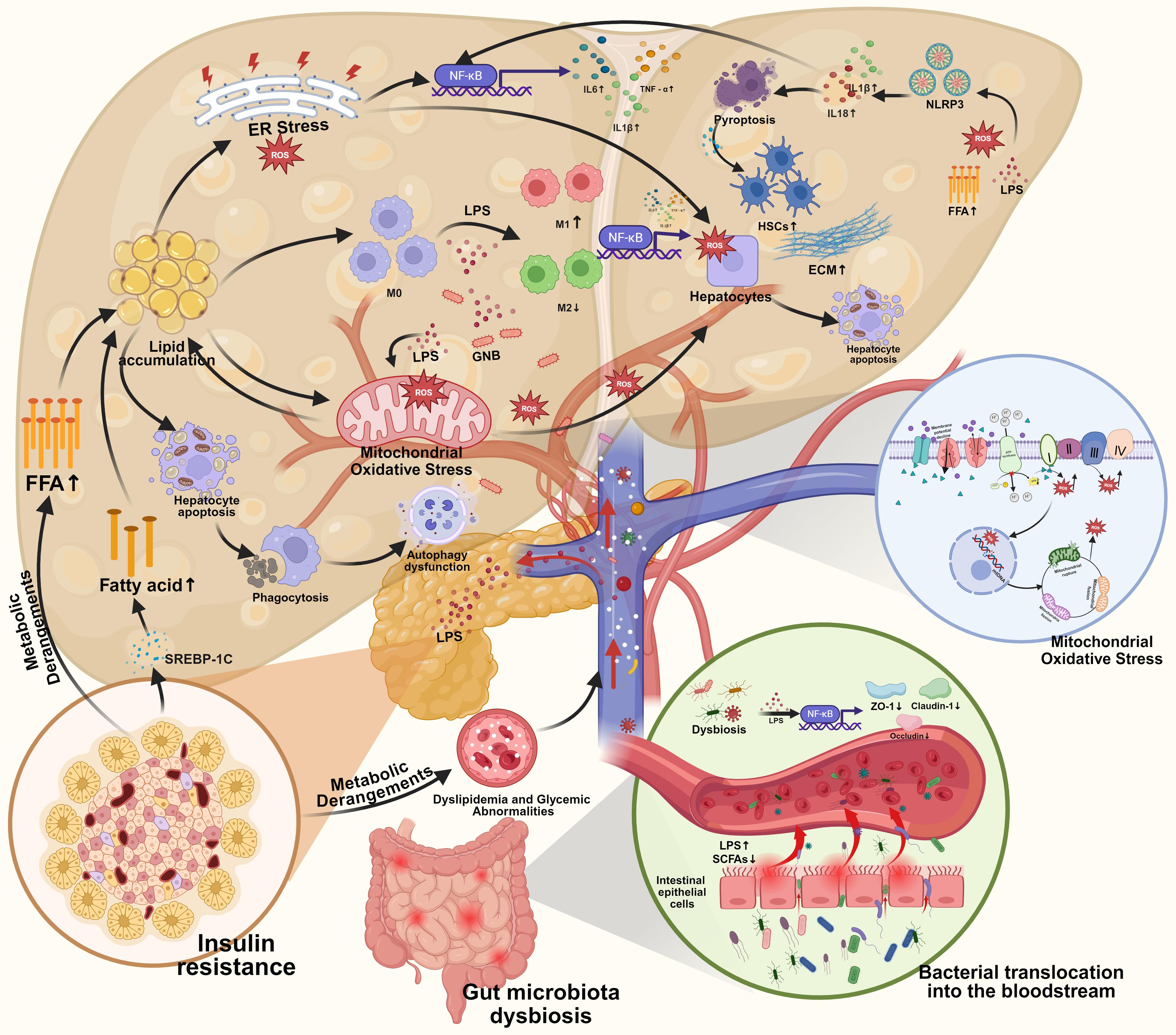 Multifactorial pathogenesis of MASLD.