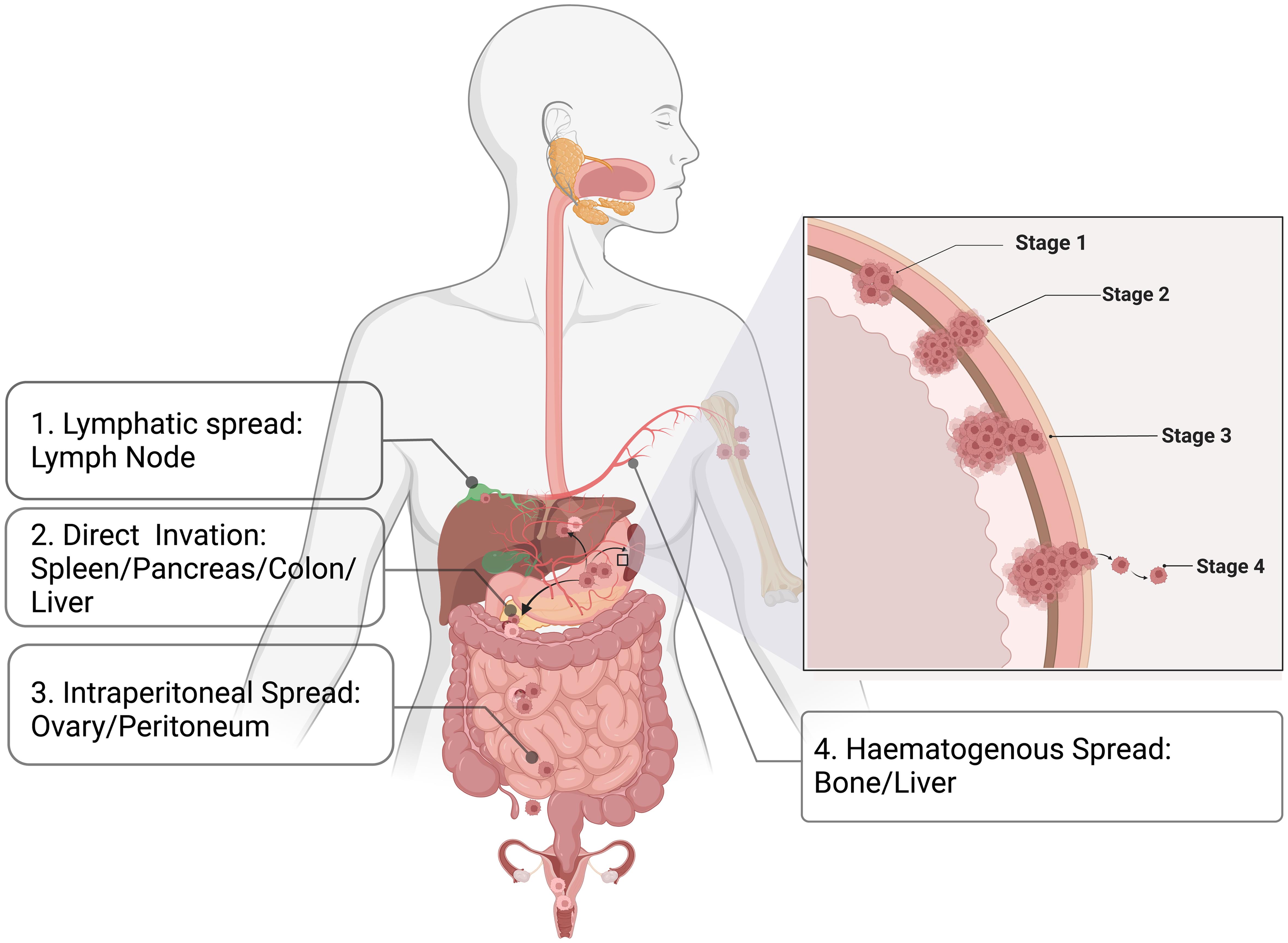 Summary of the metastatic routes and sites in gastric cancer.