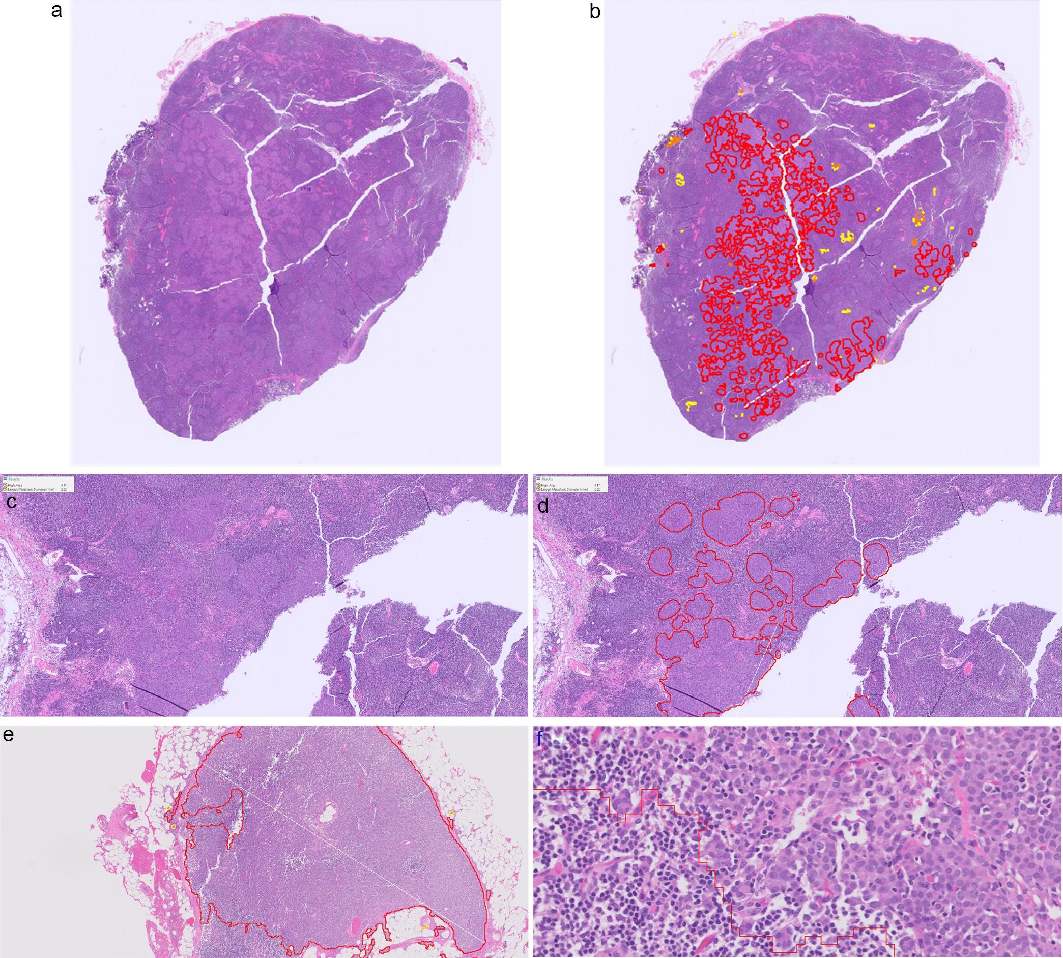 Detecting lymph node metastasis using an artificial intelligence (AI) tool in breast cancer.