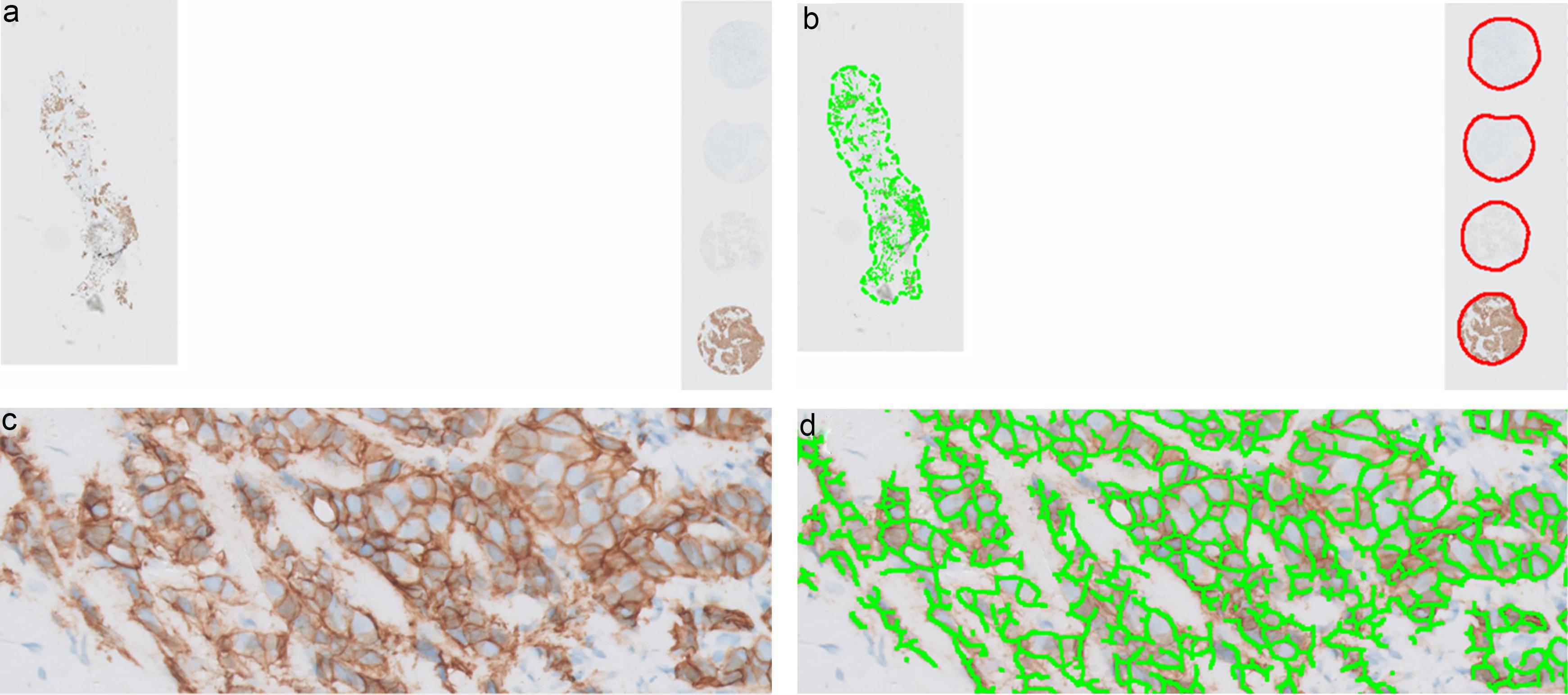 Automated quantification of HER2 immunohistochemistry (IHC) using an AI tool in breast cancer.