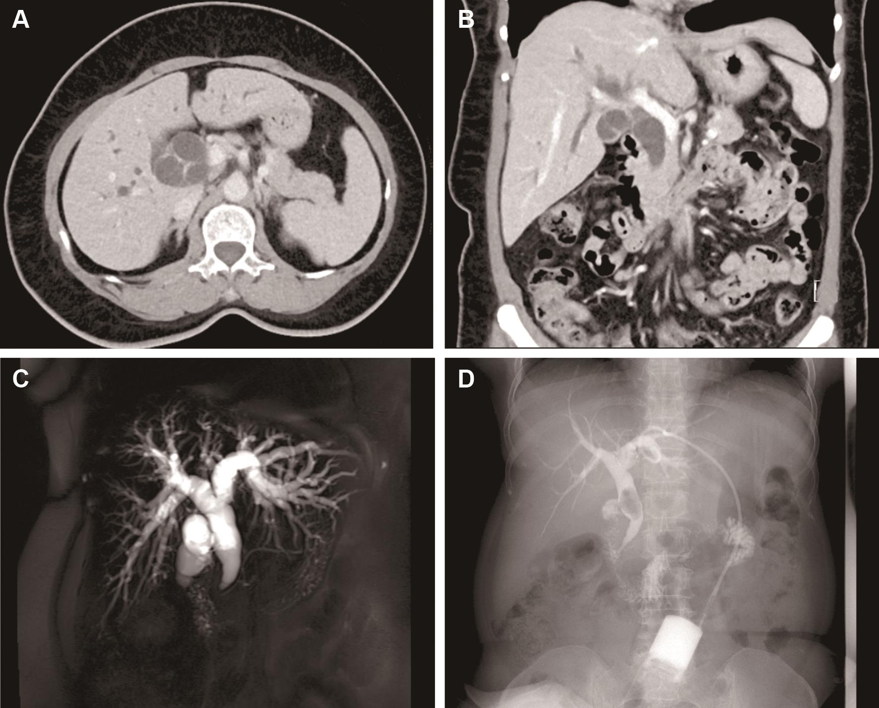 Preoperative imaging revealed biliary obstruction.