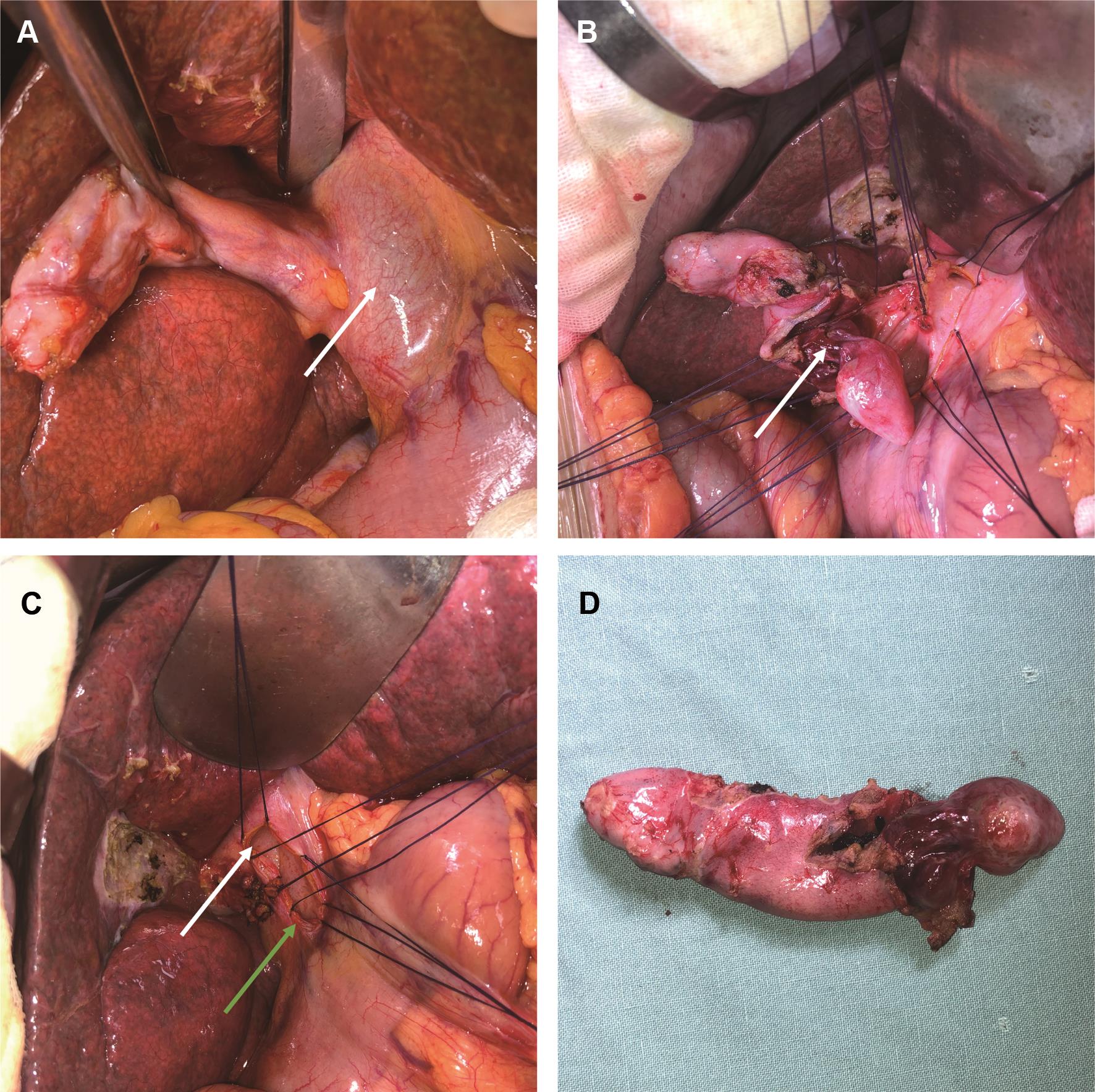 A cystic duct-origin mass was found during the operation to block the common bile duct.