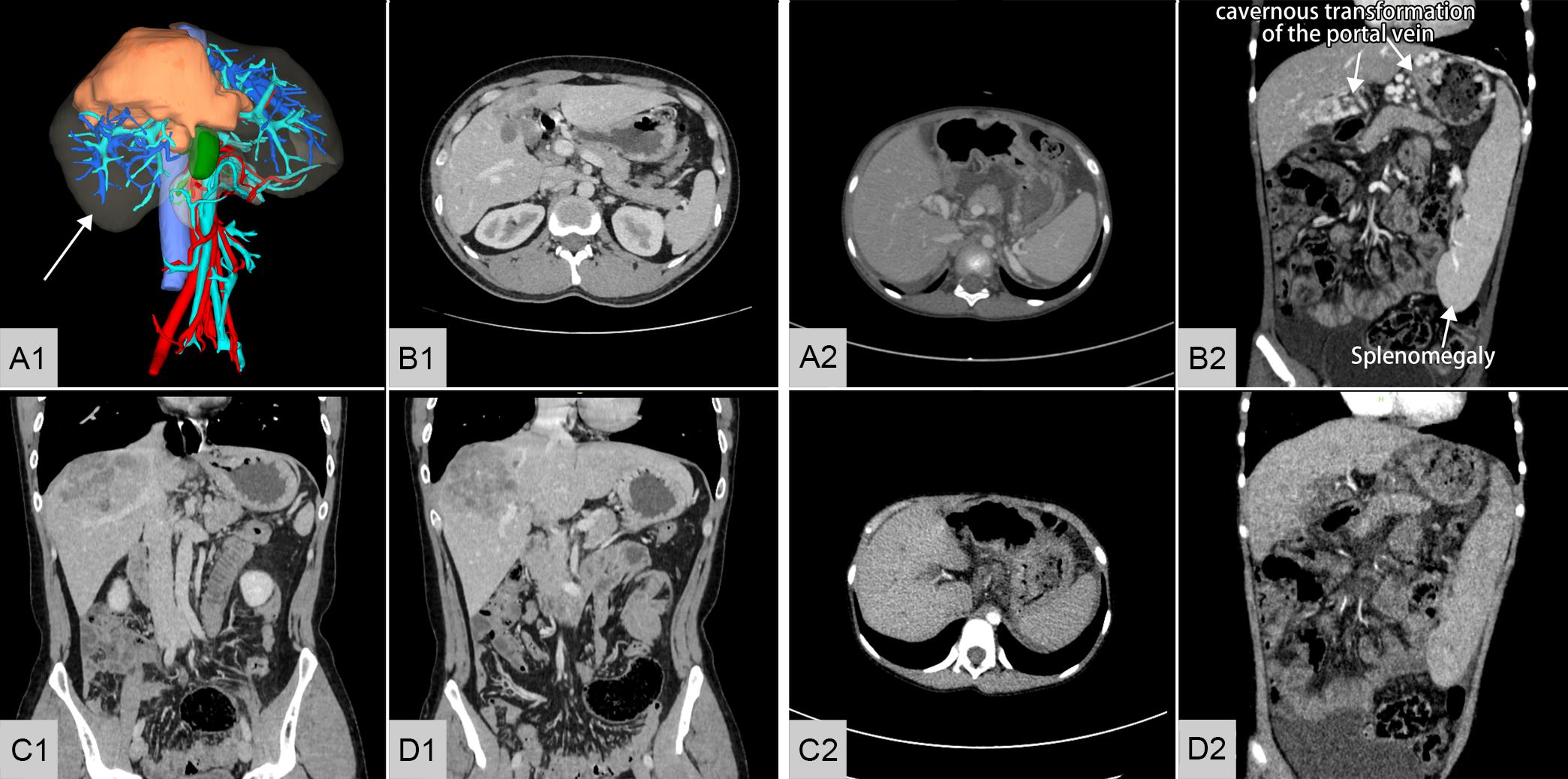 The enhanced CT scan and 3D model of the two patients.