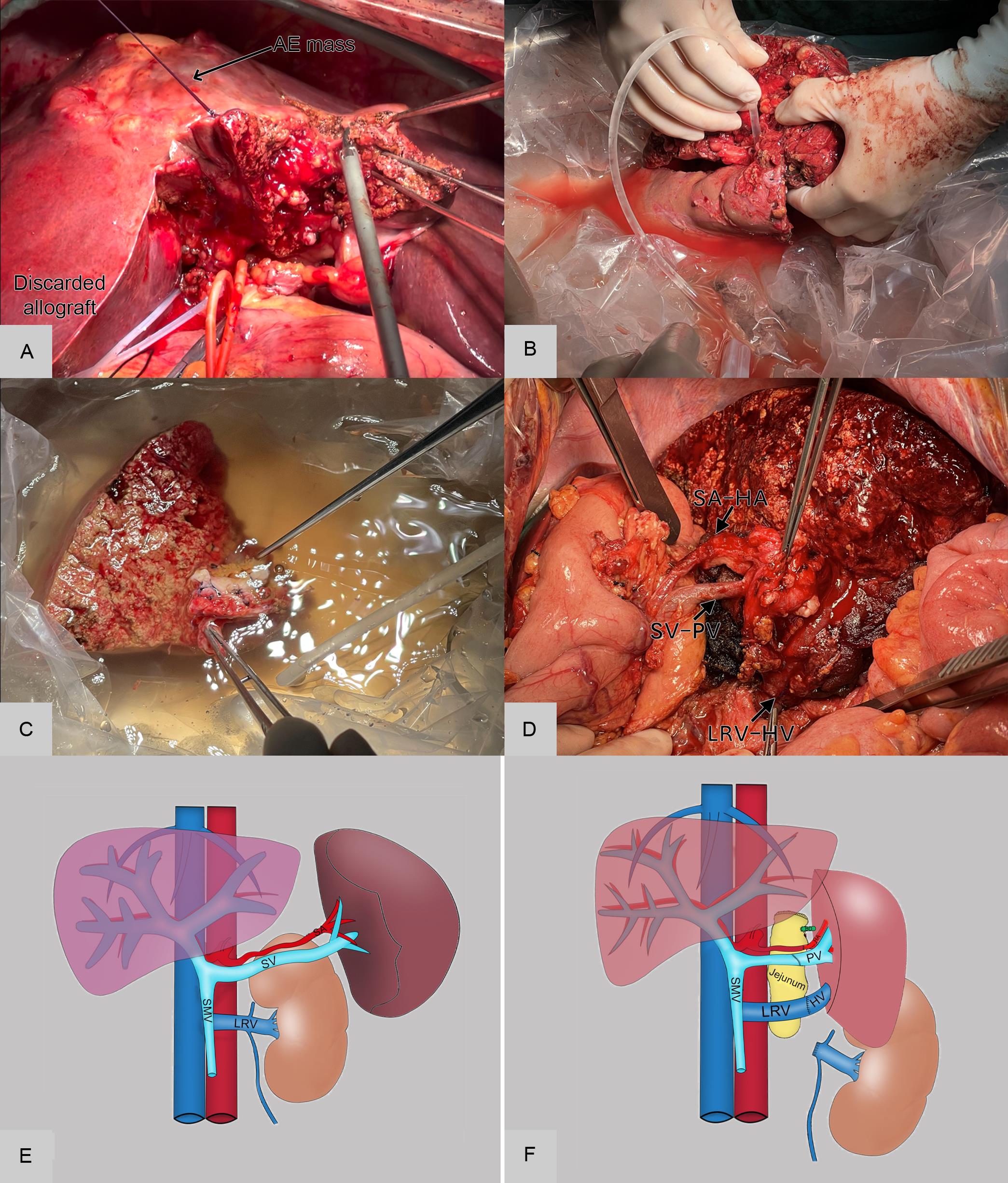 The brief procedure for the surgery and schematic diagram.