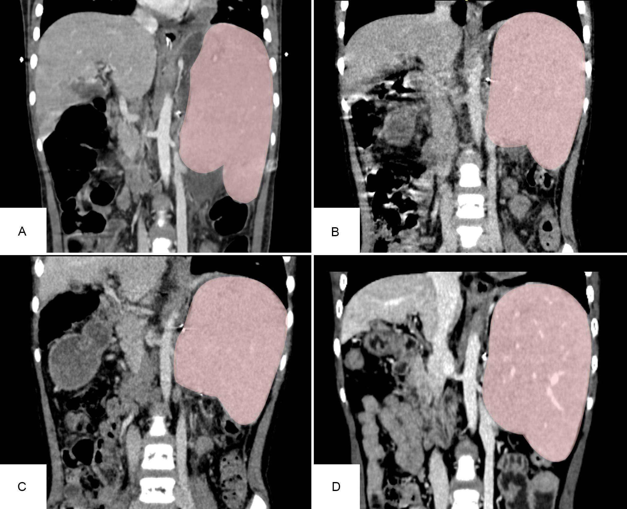 The volumes of the girl’s native and transplant liver.