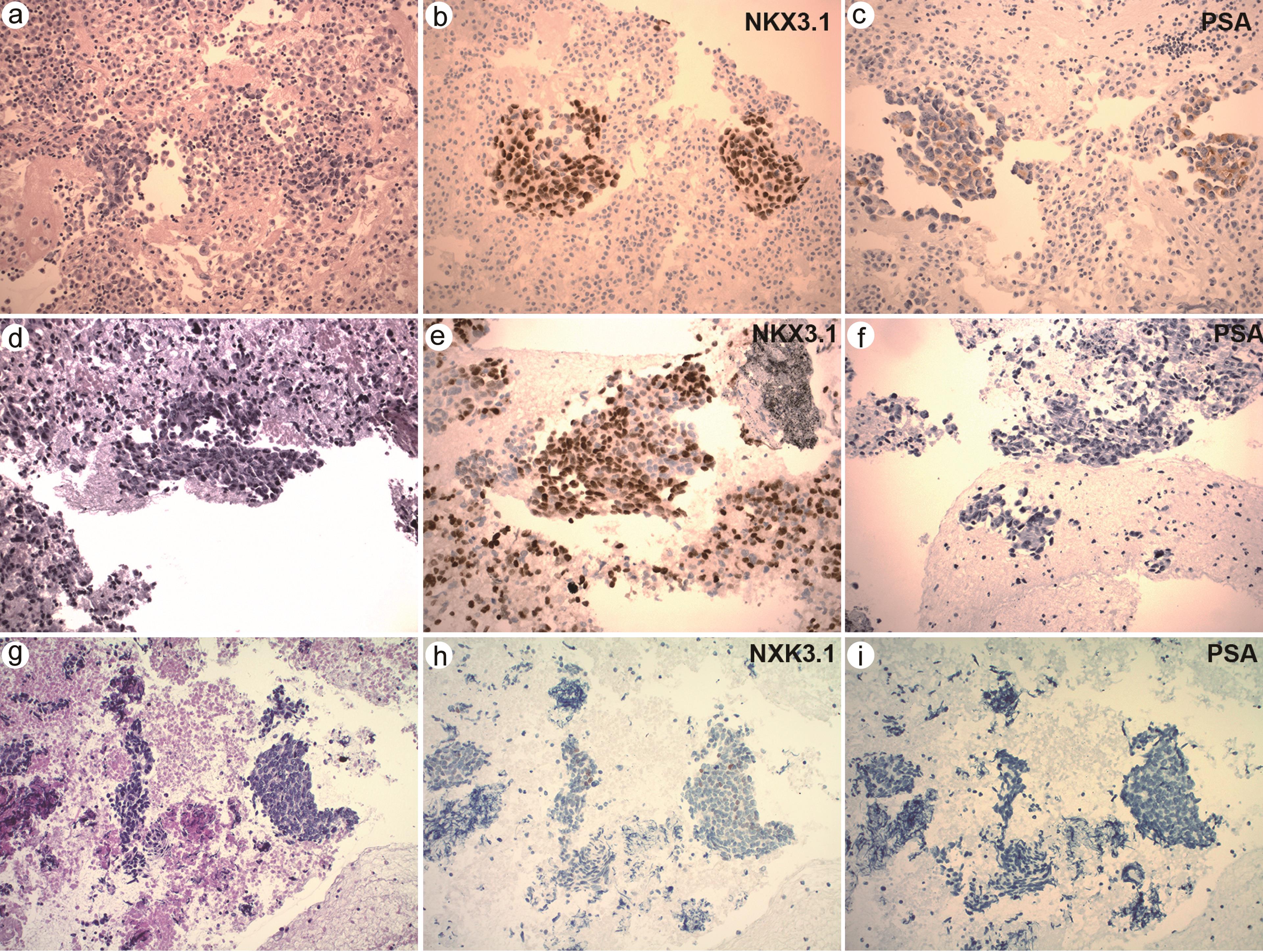 a–c: A representative case of metastatic prostatic adenocarcinoma (a) with positive NKX3.1 (b) and positive PSA (c). d–f: A representative case of metastatic prostatic adenocarcinoma (d) with positive NKX3.1 (e) but negative PSA (f). g–i: The only non-metastatic prostatic carcinoma with focal weak NKX3.1 positivity but negative PSA. a–i: 200×.