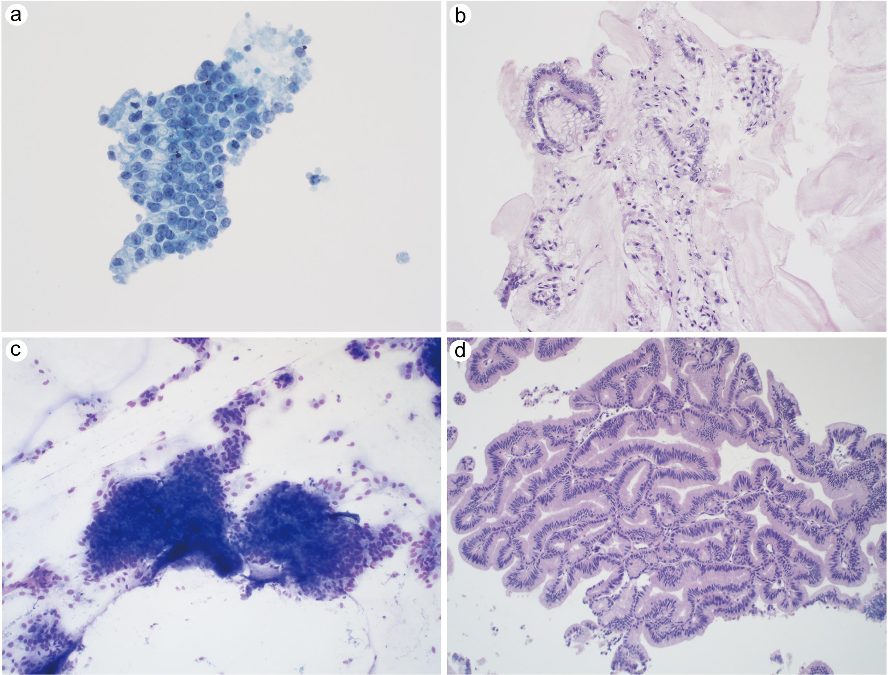 Pancreaticobiliary neoplasm, low grade.