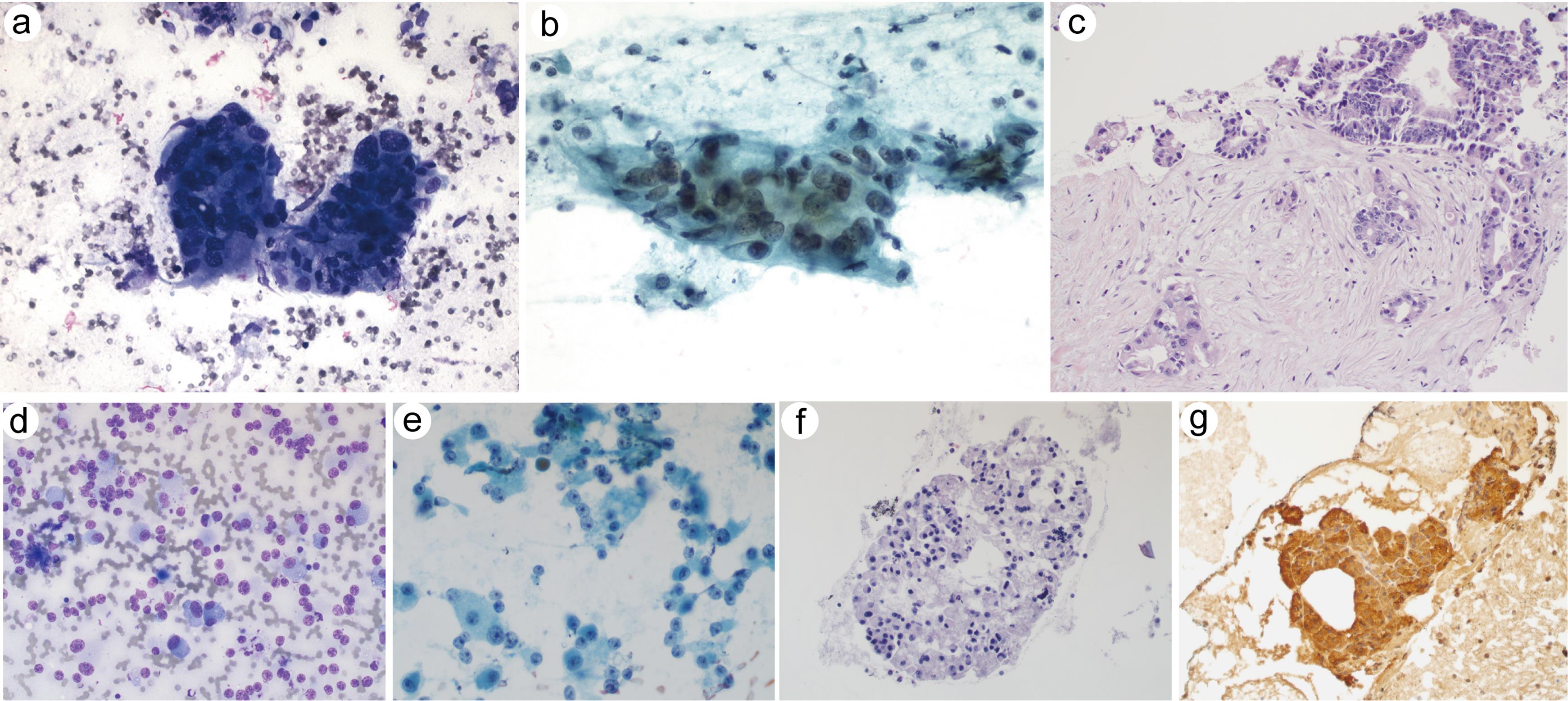 Primary pancreatic malignant neoplasm.