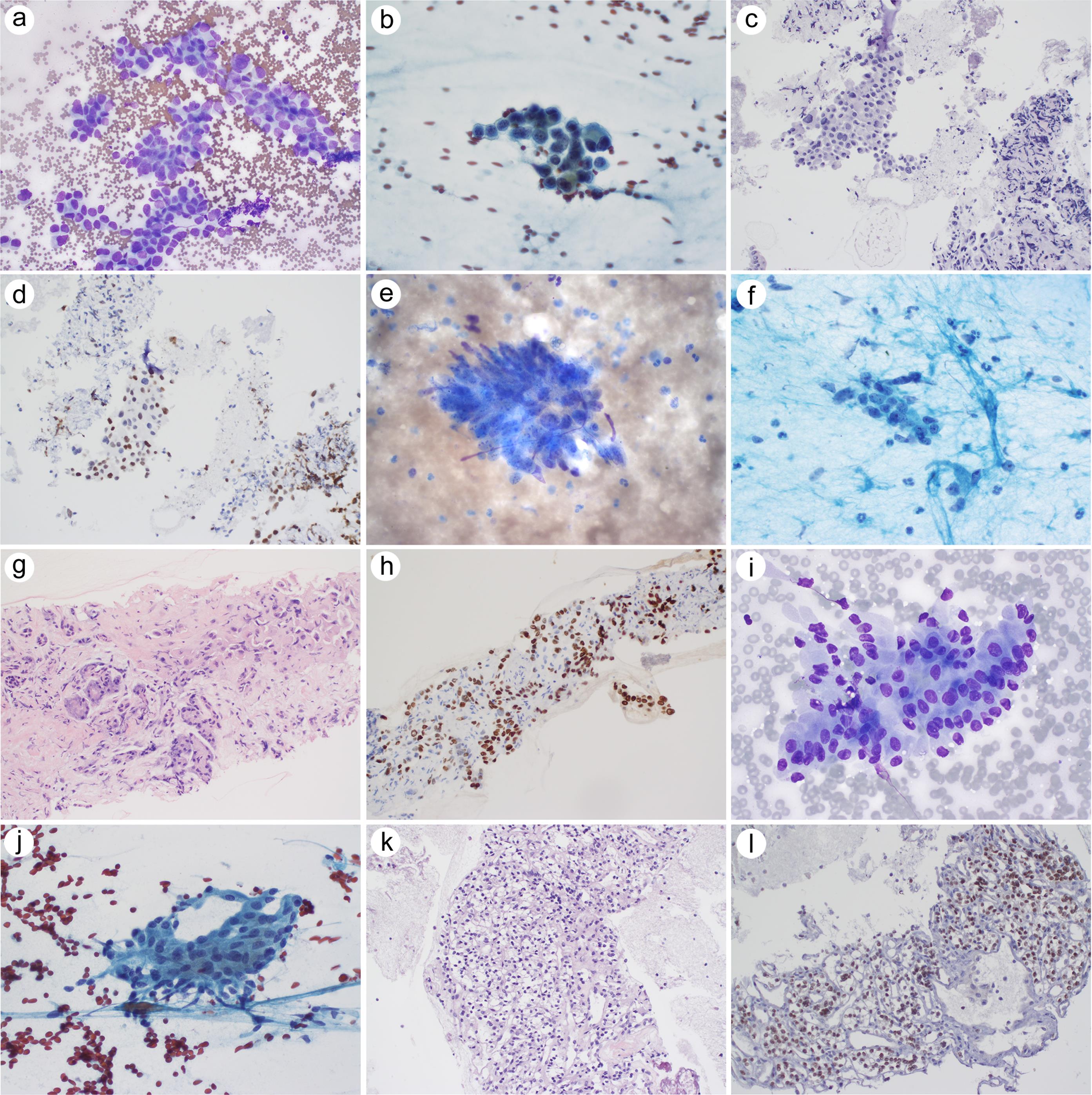 Metastatic carcinoma in pancreas.