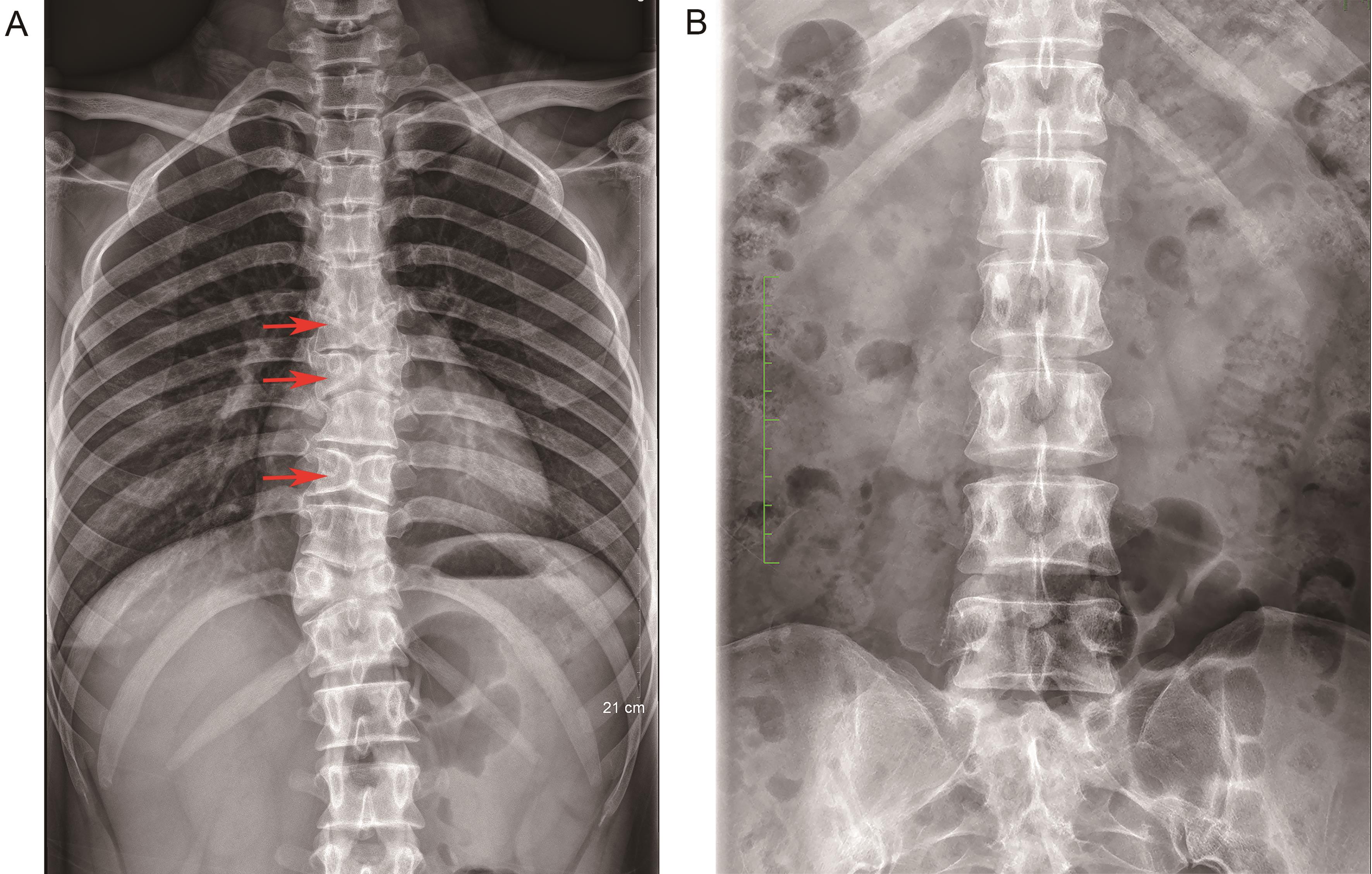 Clinical and Genetic Characteristics of Alagille Syndrome in Adults