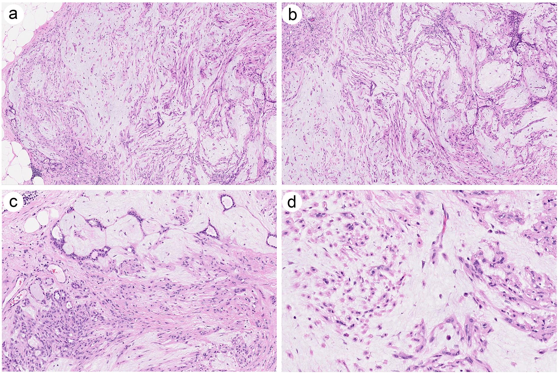 Histologic features of pleomorphic adenoma.