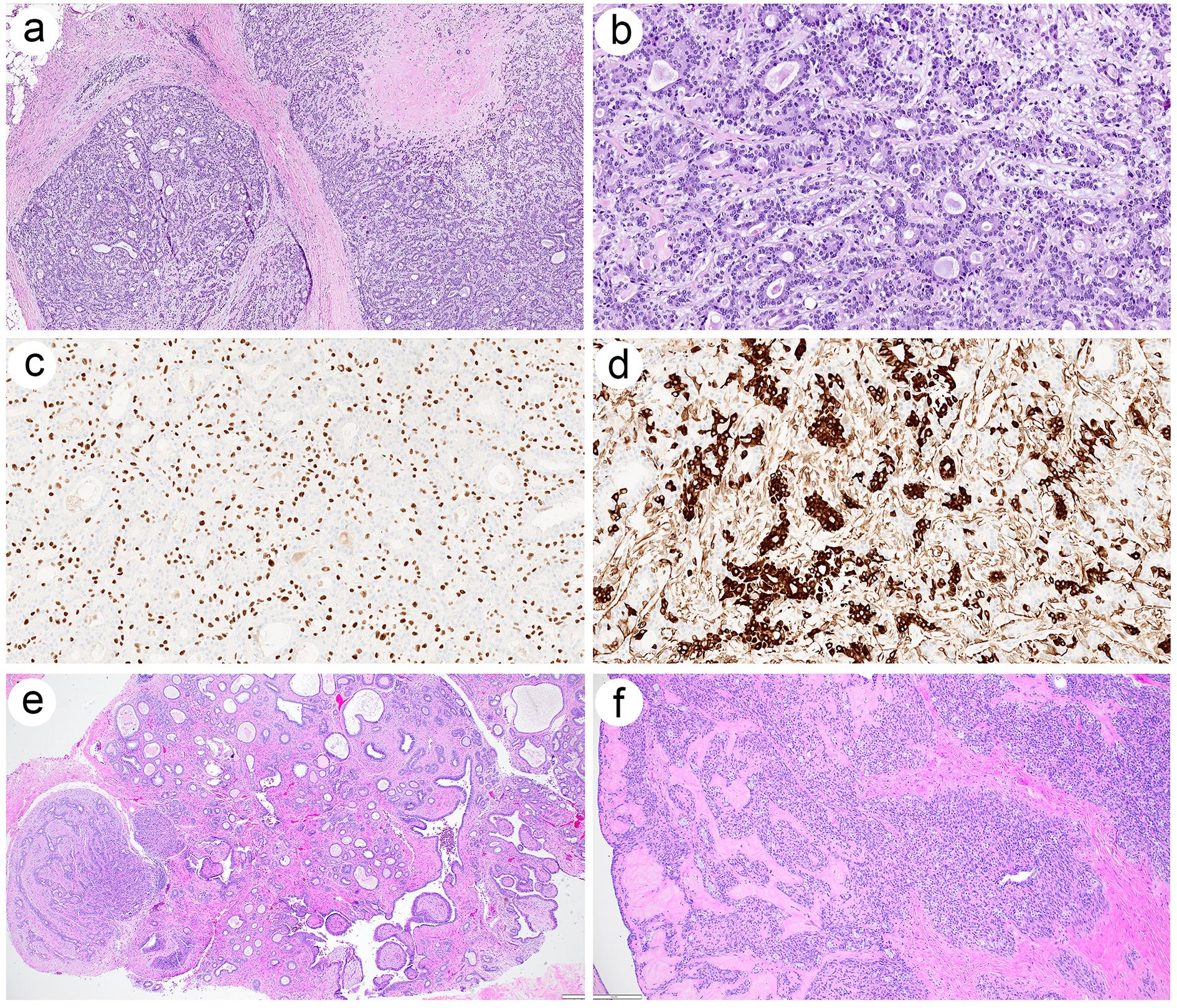 Histologic and immunophenotypic features of adenomyoepithelioma.