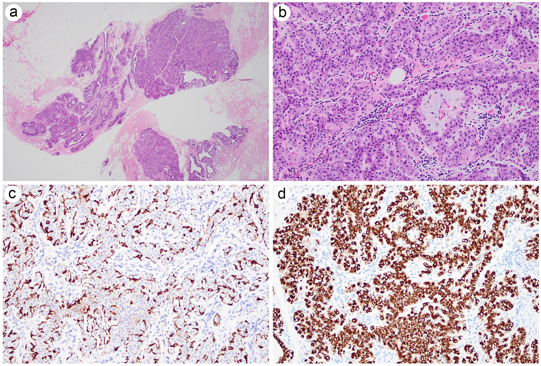 Histologic and immunophenotypic features of adenomyoepithelioma.