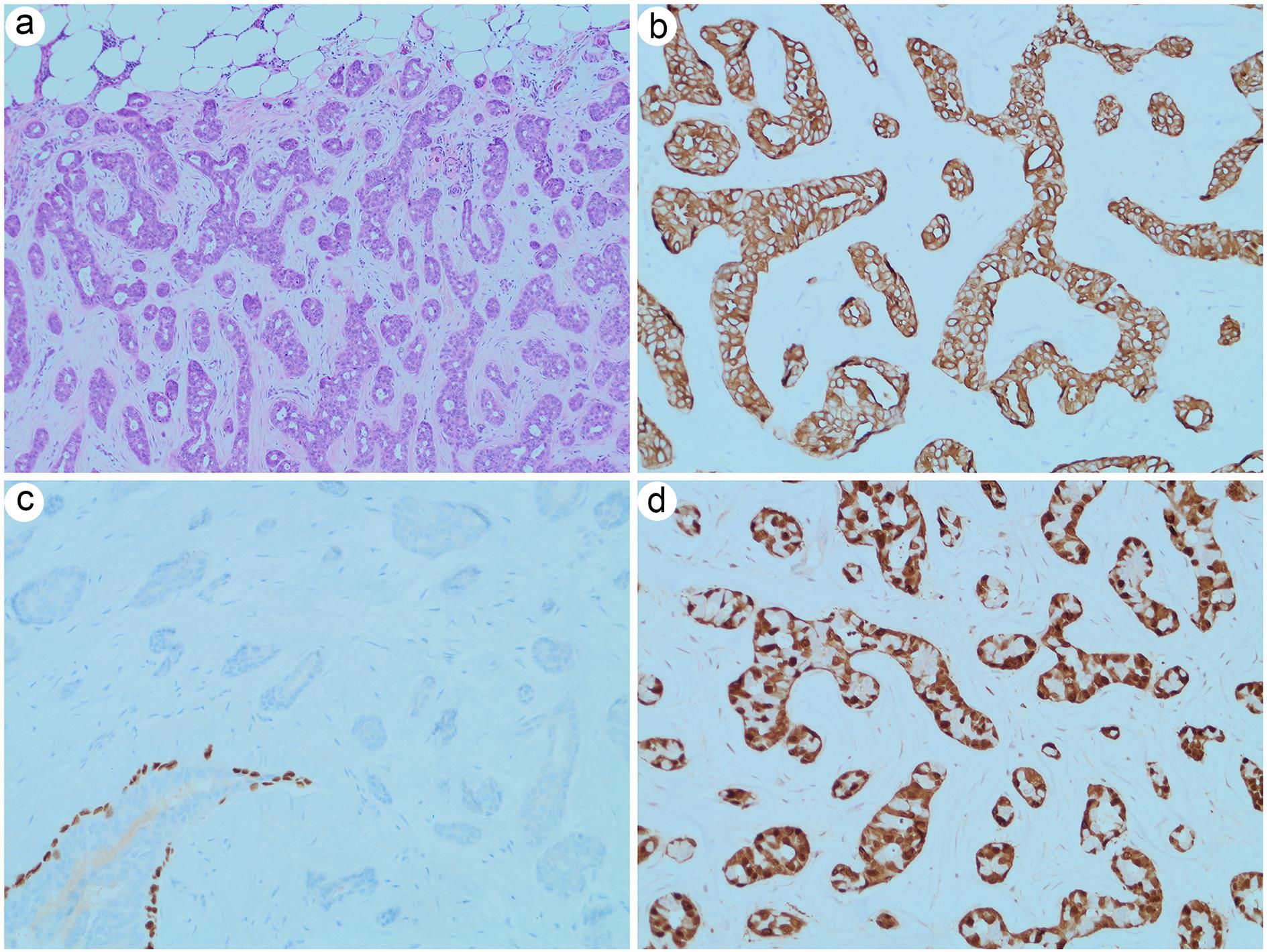 Variable expression of myoepithelial markers in adenomyoepithelioma.