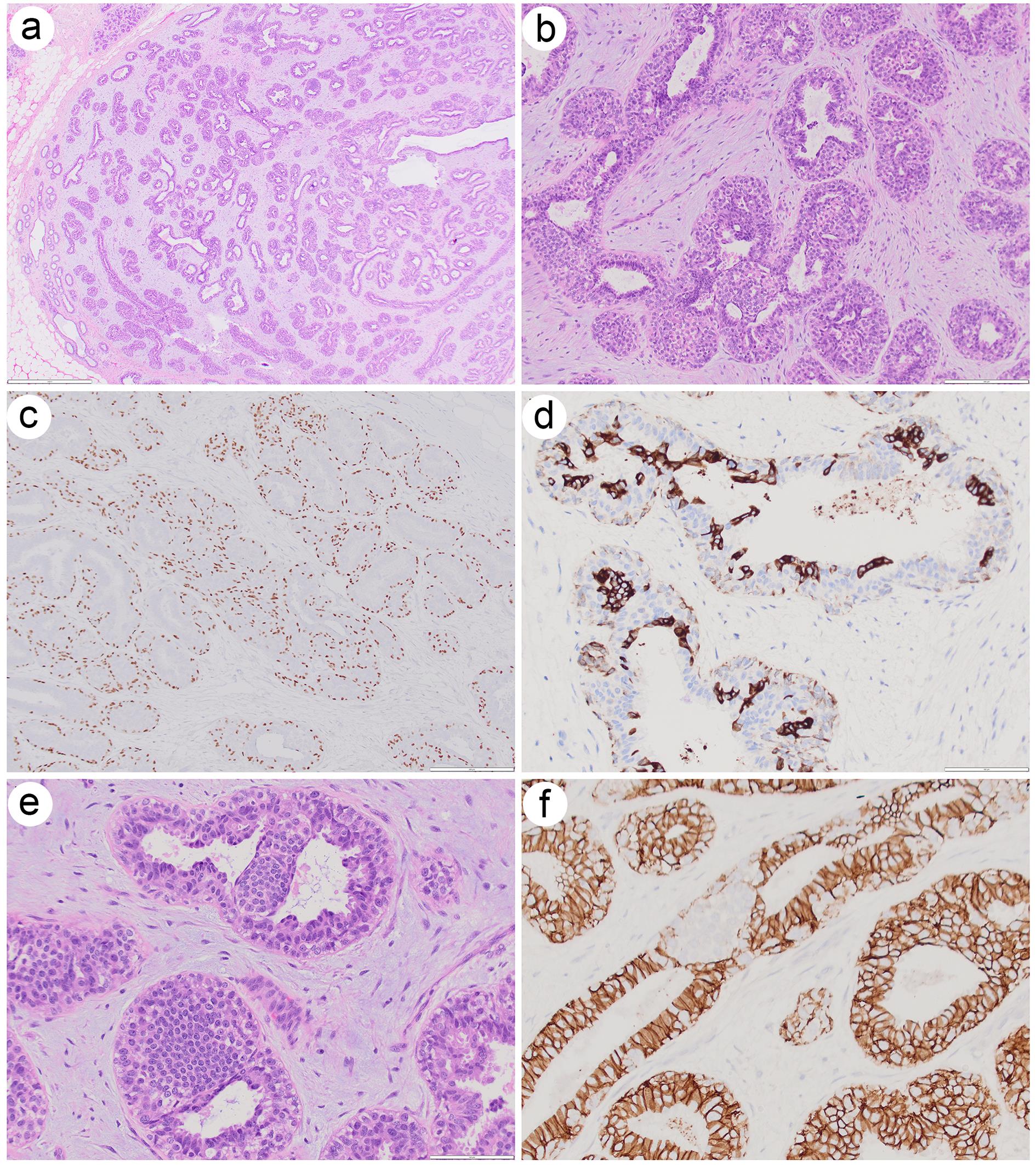 Atypical ductal hyperplasia and atypical lobular hyperplasia arising in adenomyoepithelioma.