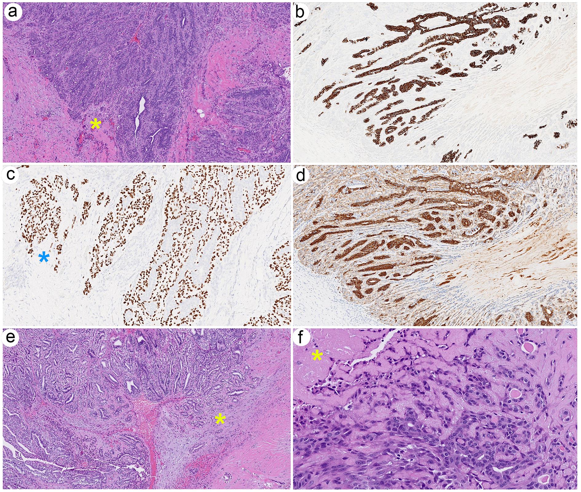 Histologic and immunophenotypic features of malignant adenomyoepithelioma.
