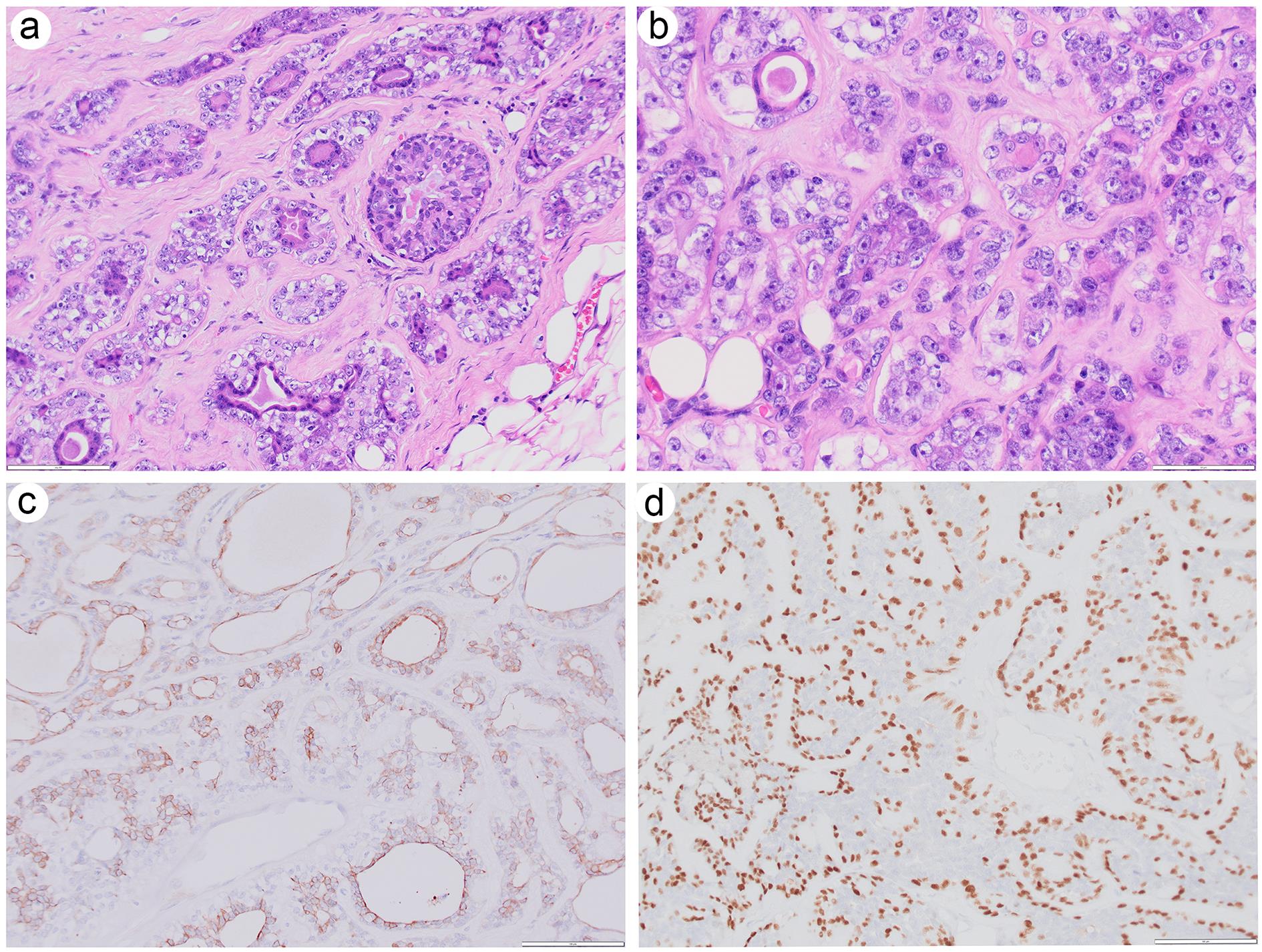 Histologic and immunophenotypic features of malignant adenomyoepithelioma with biphasic malignant epithelial and myoepithelial components (epithelial-myoepithelial carcinoma).