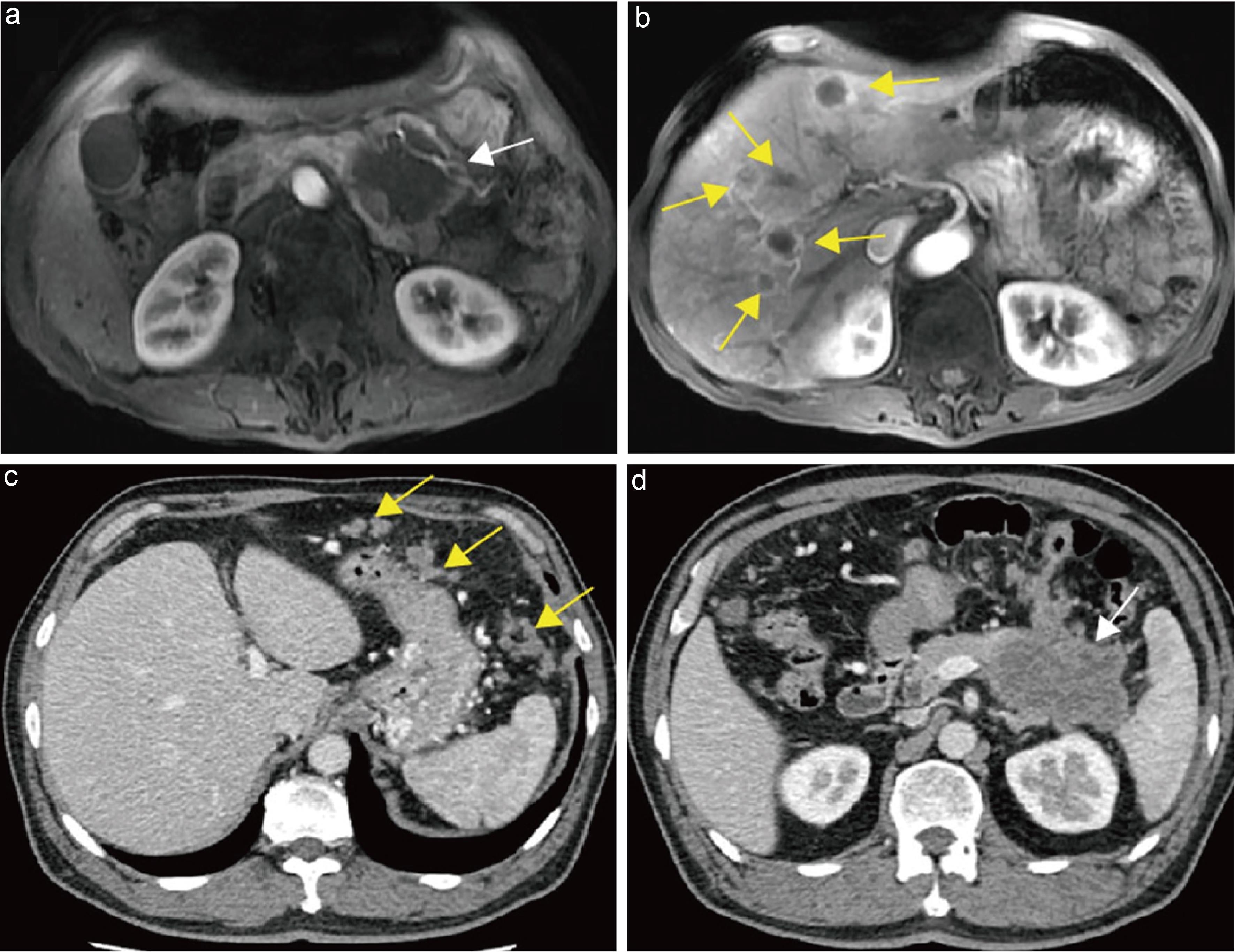Evaluation of hepatic and distant metastases in pancreatic cancer.