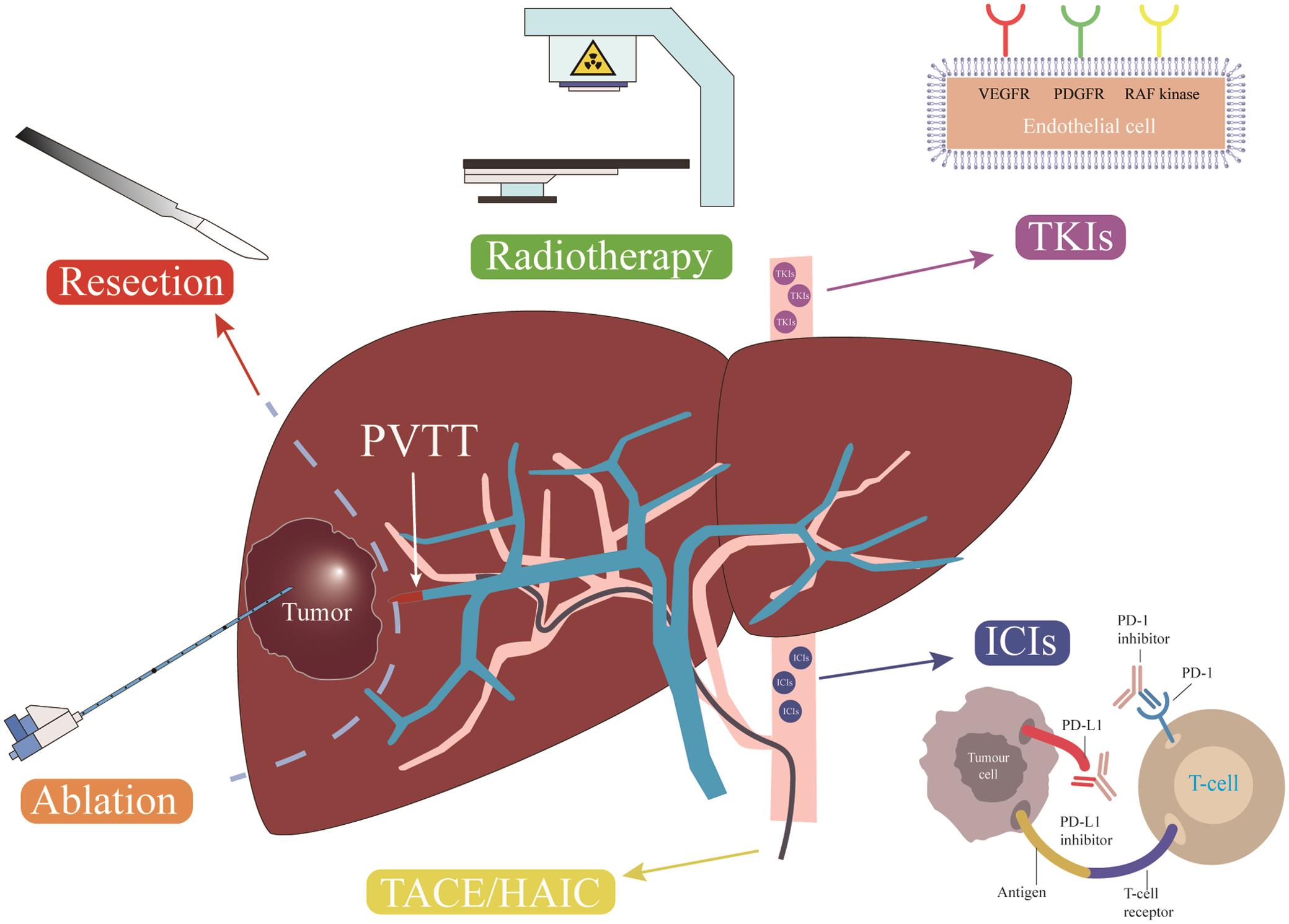 Different therapeutic methods have different mechanisms of action for patients with HCC involving PVTT.
