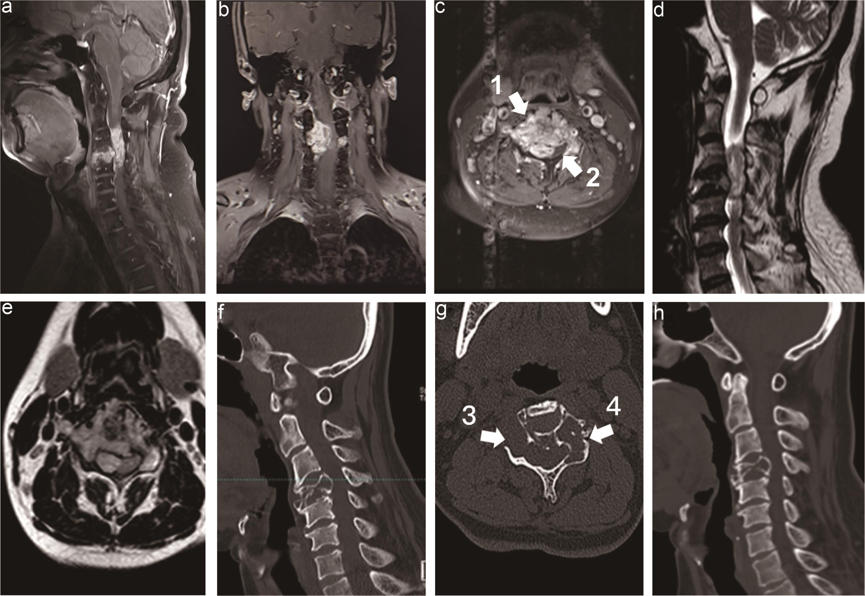 Preoperative cervical MRI and CT.