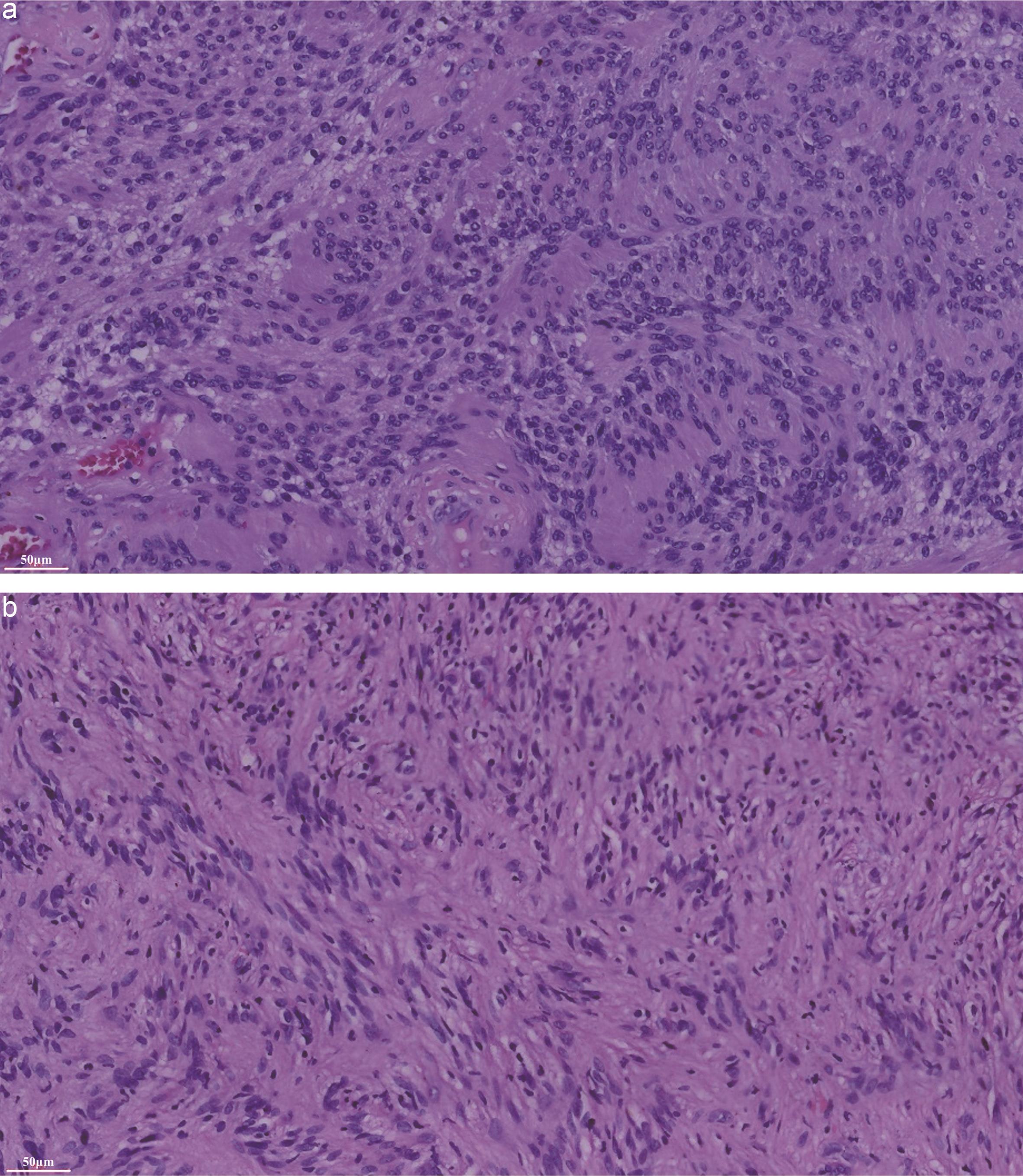 The tumor tissue was removed (a) during the first operation and (b) during the second operation.
