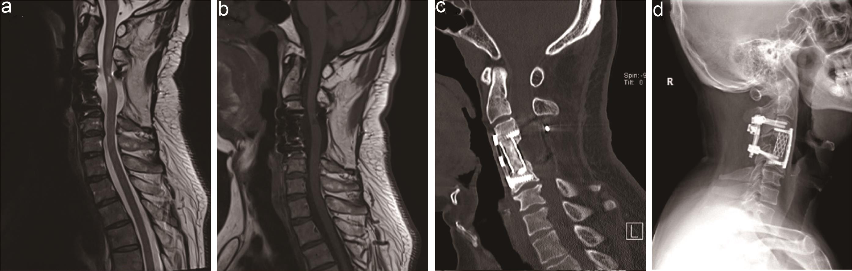 Follow-up MRI, CT, and X-ray 12 months after surgery.