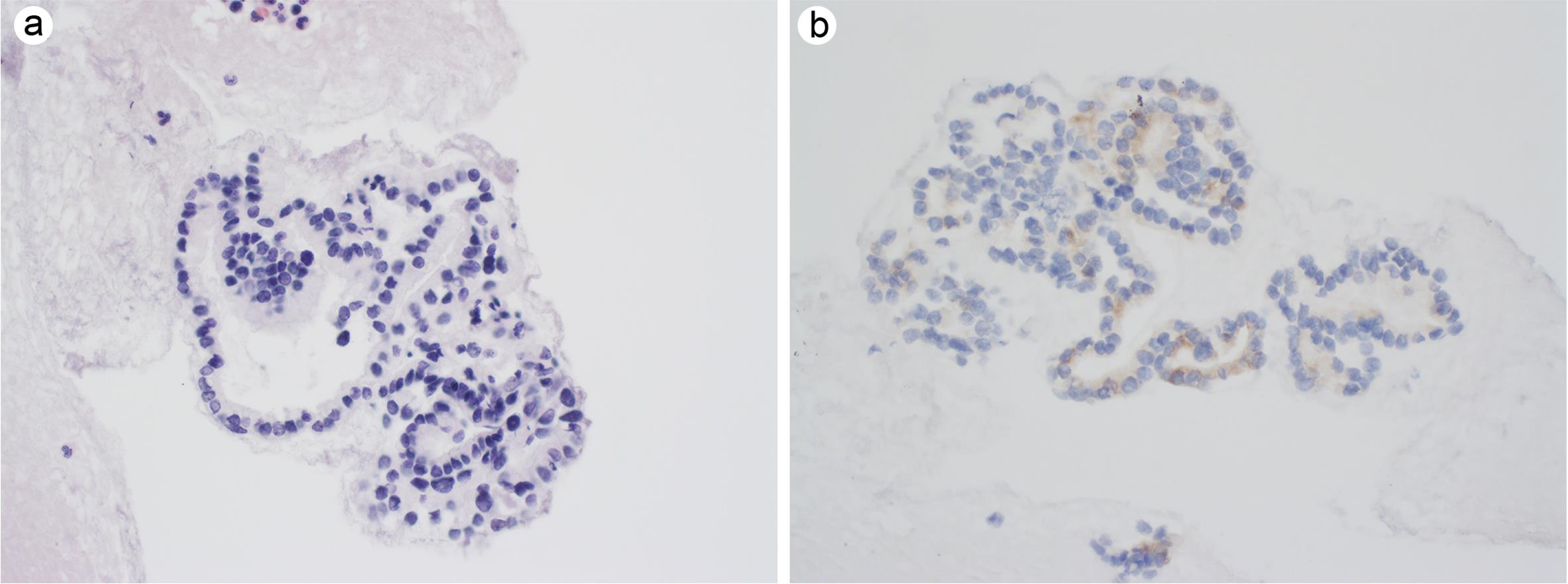 Serous cystadenoma.