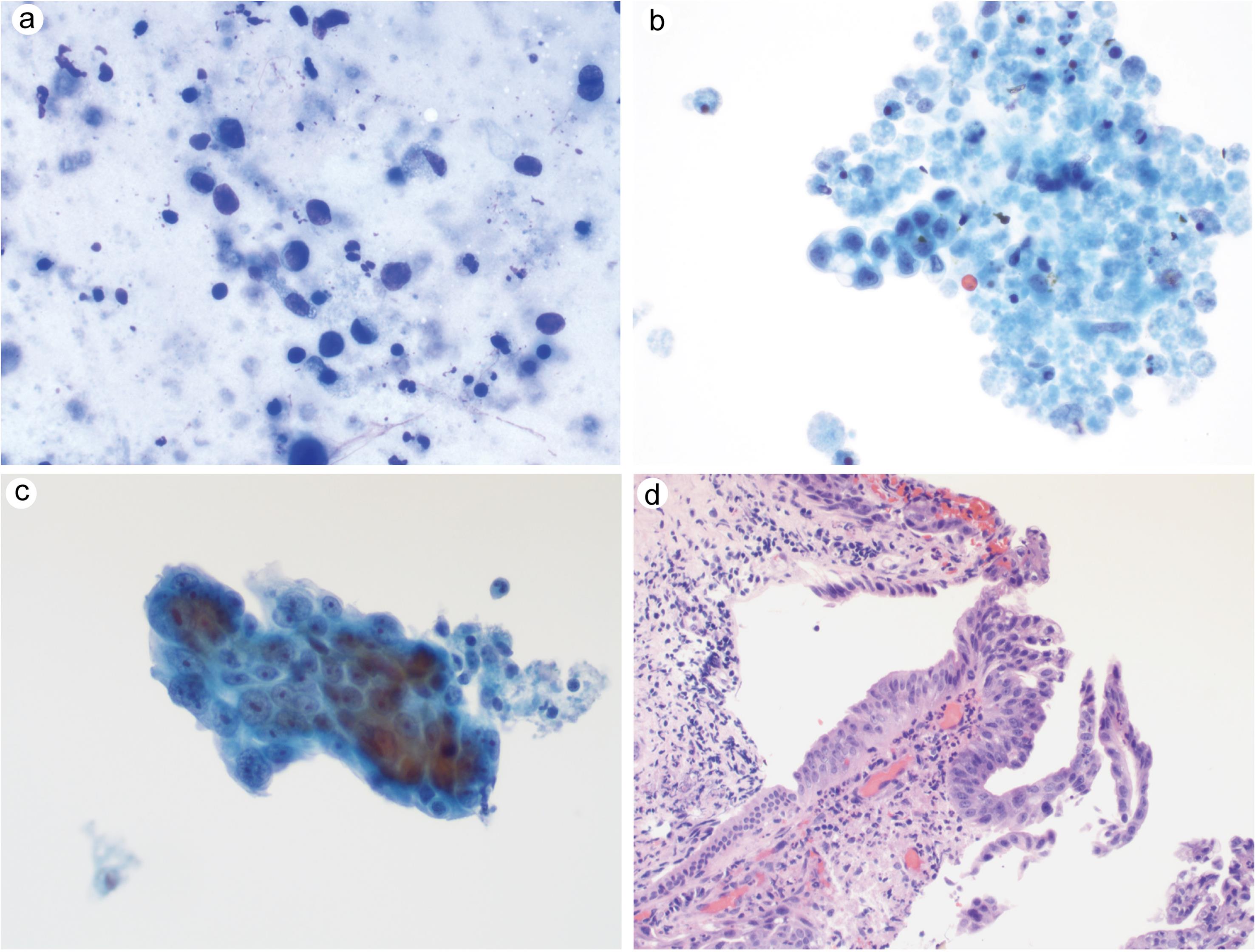 Pancreaticobiliary neoplasm, high grade.