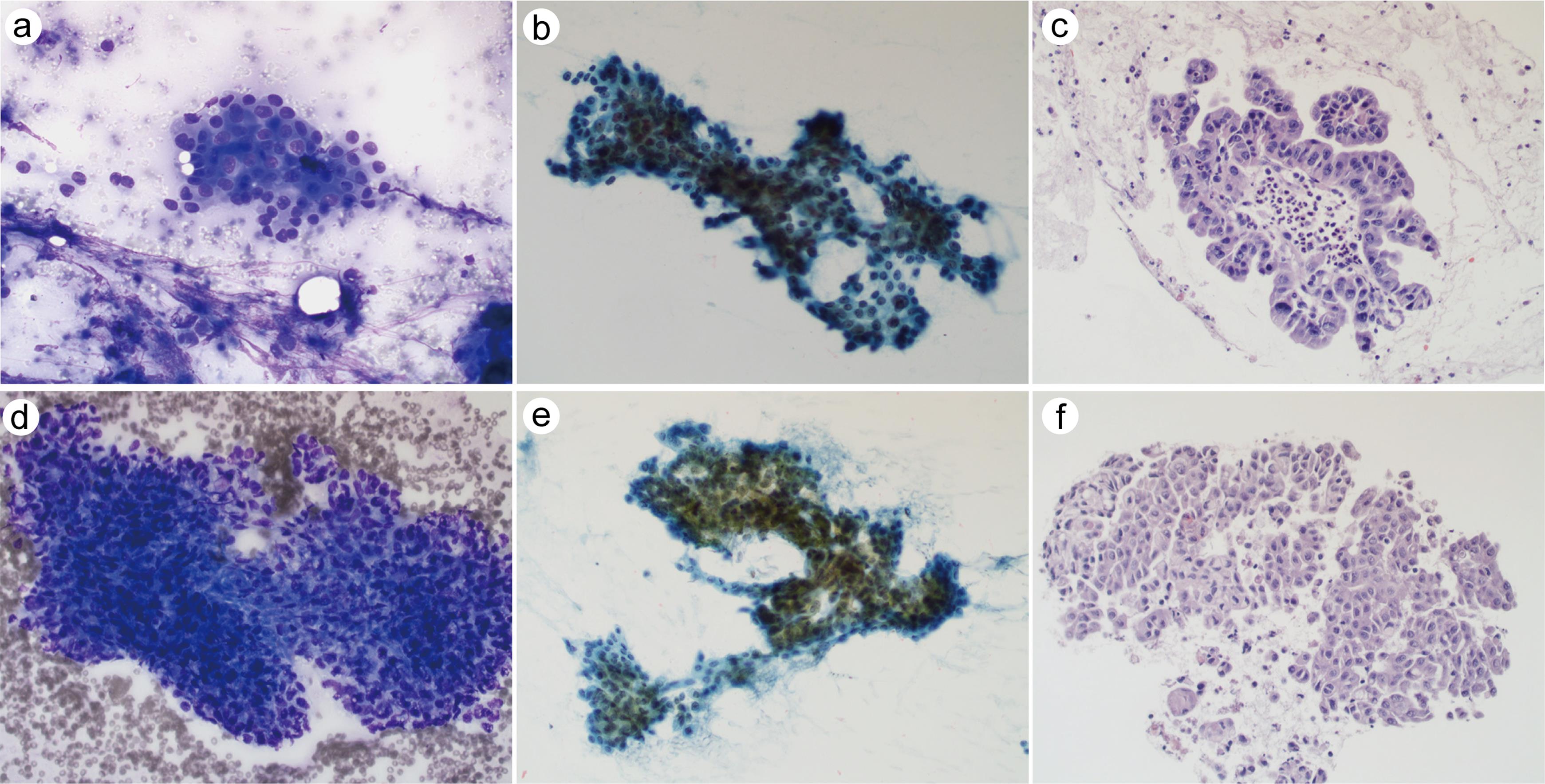 Pancreaticobiliary neoplasm, high grade.