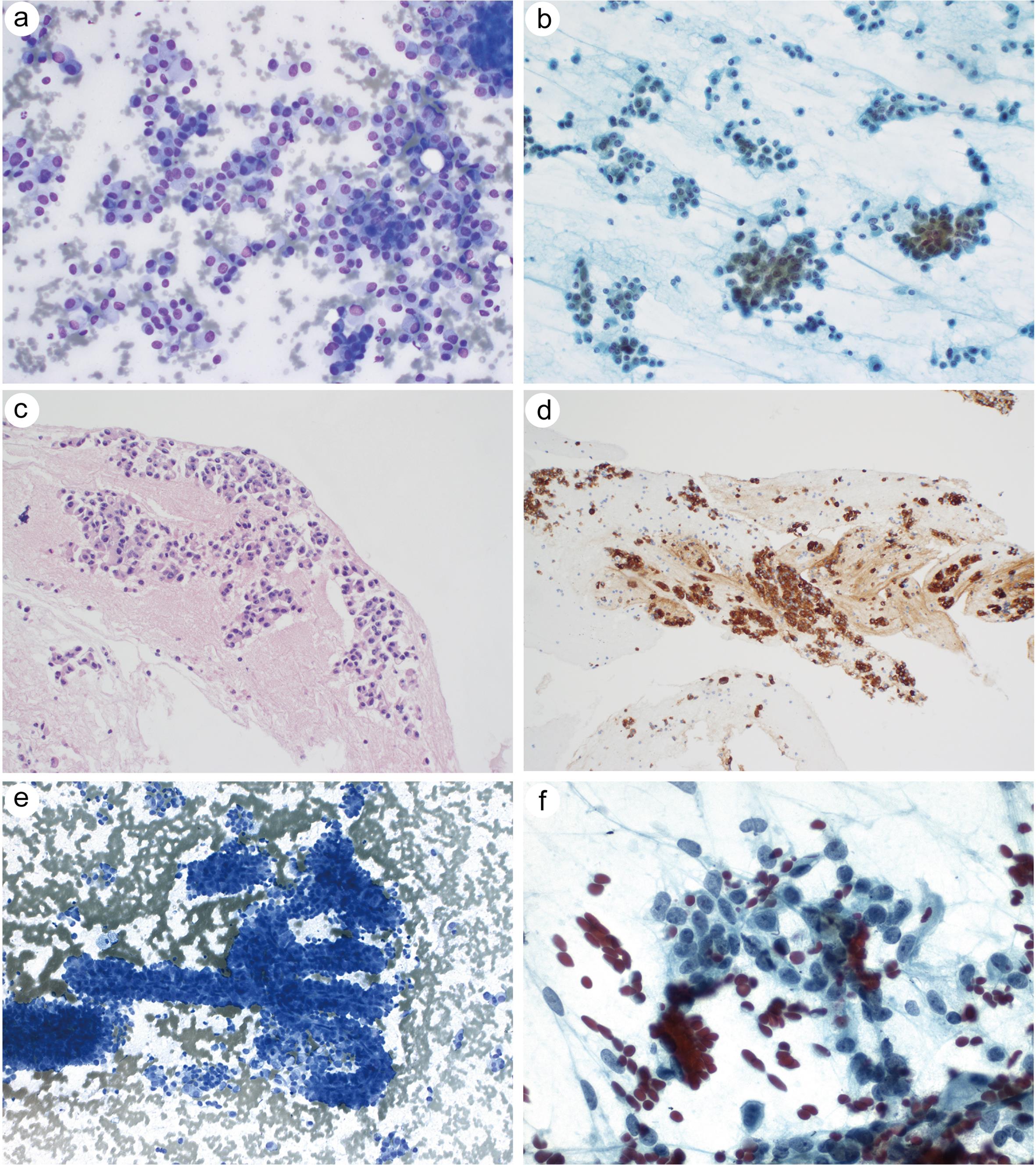 Primary pancreatic malignant neoplasm.