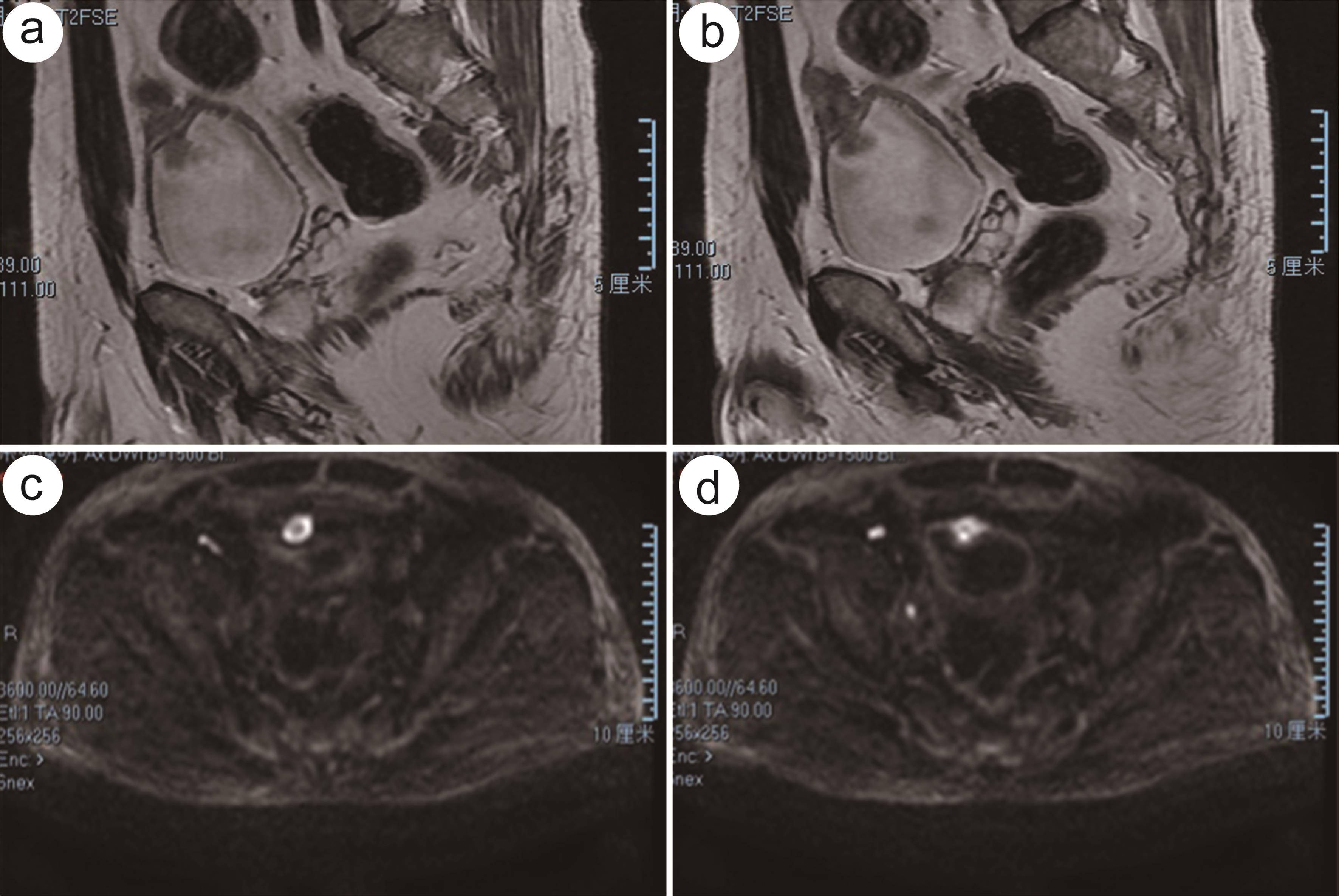 MRI showed that it was located at the junction of bladder and urachal, showing infiltrative growth (a, b). It was a predominantly high signal on diffusion-weighted imaging images with a low signal shadow visible within it (c, d).