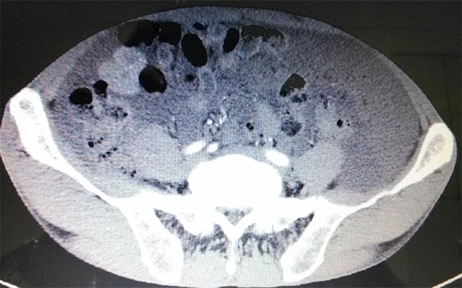 The tumor metastasized widely in the abdominal cavity.