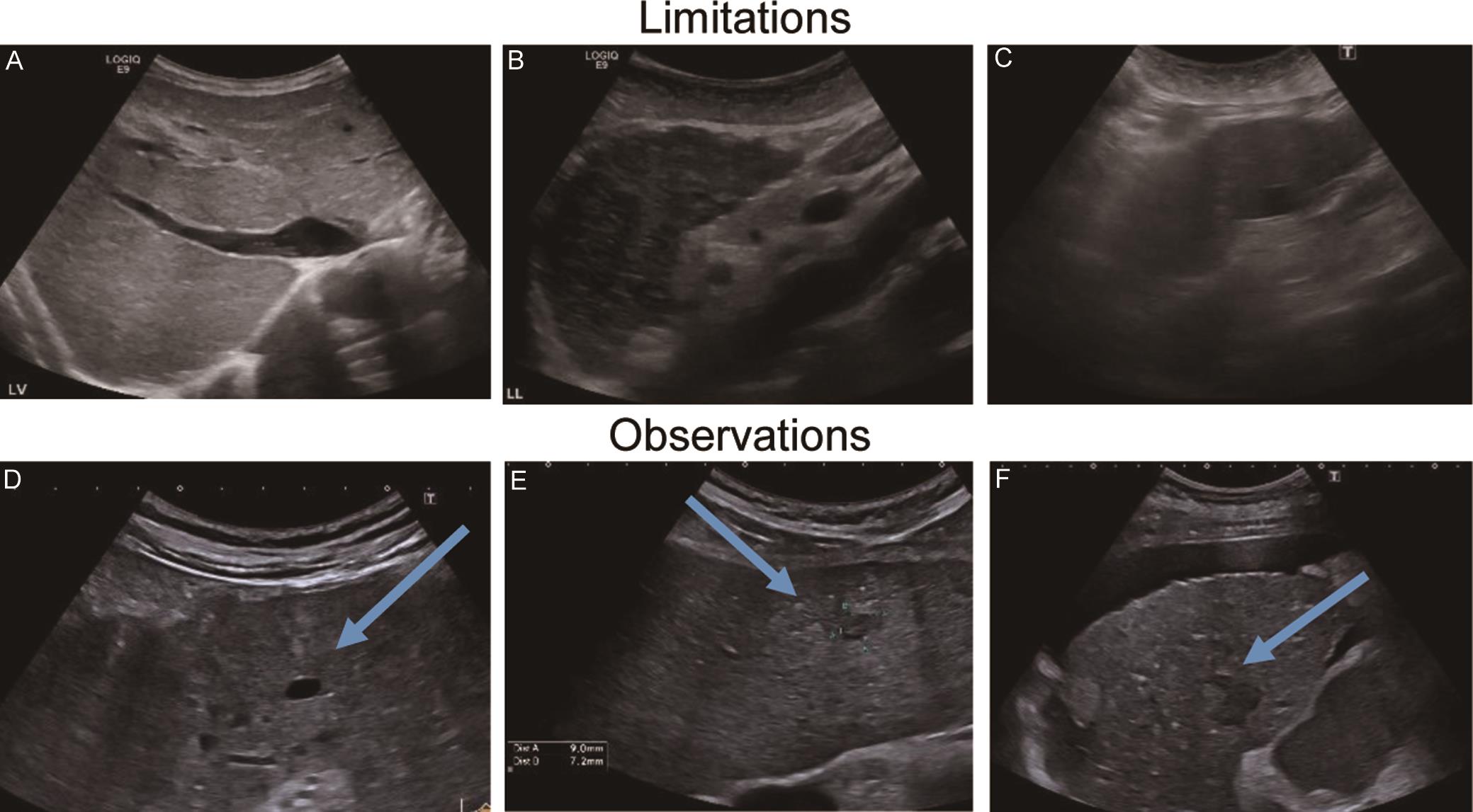 Scoring of visual limitations (upper panel, A–C) and observations (lower panel, D–F) in ultrasound, adapted by Fetzer <italic>et al</italic>.