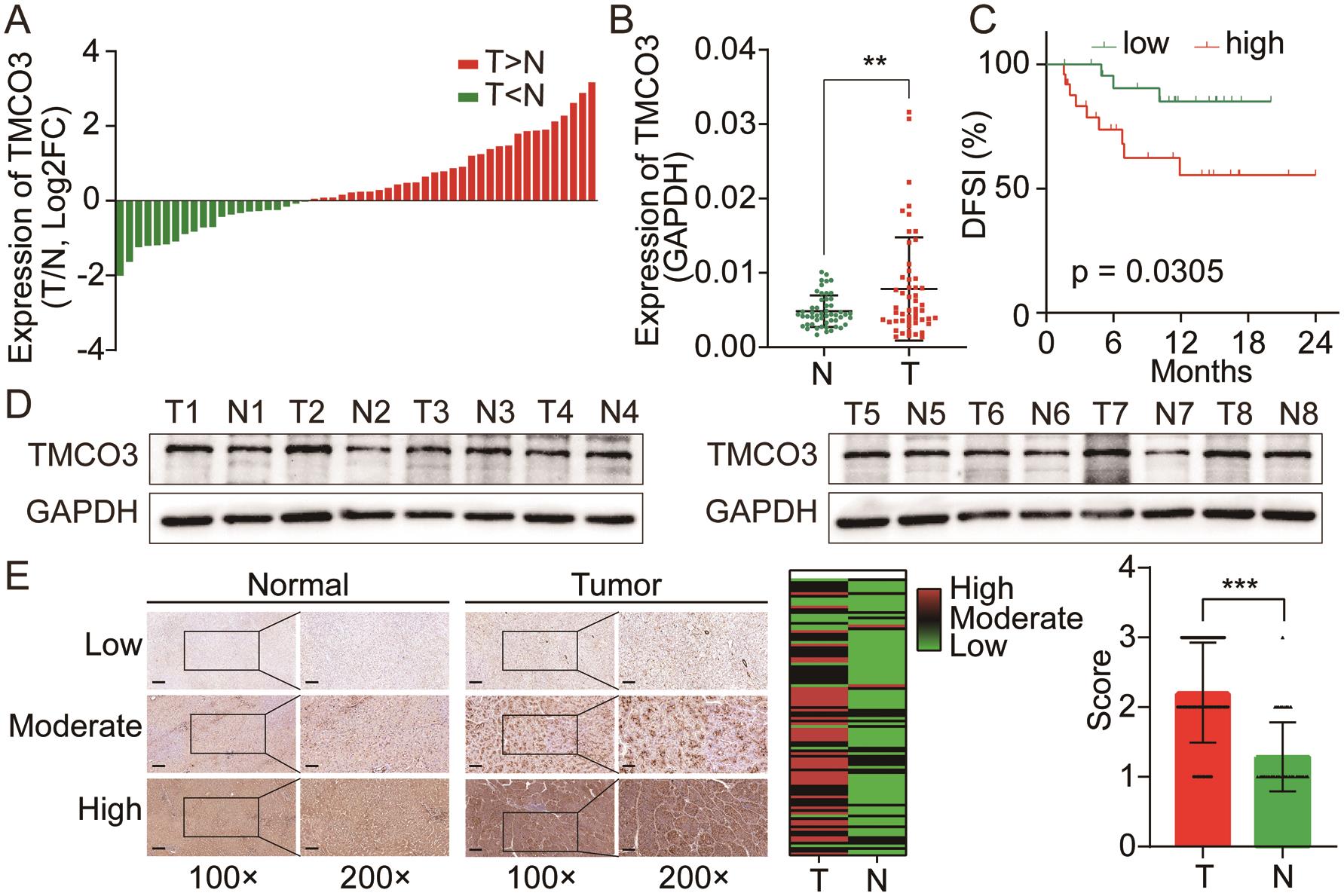 Validation of TMCO3 expression in the HCC cohort from our institution.