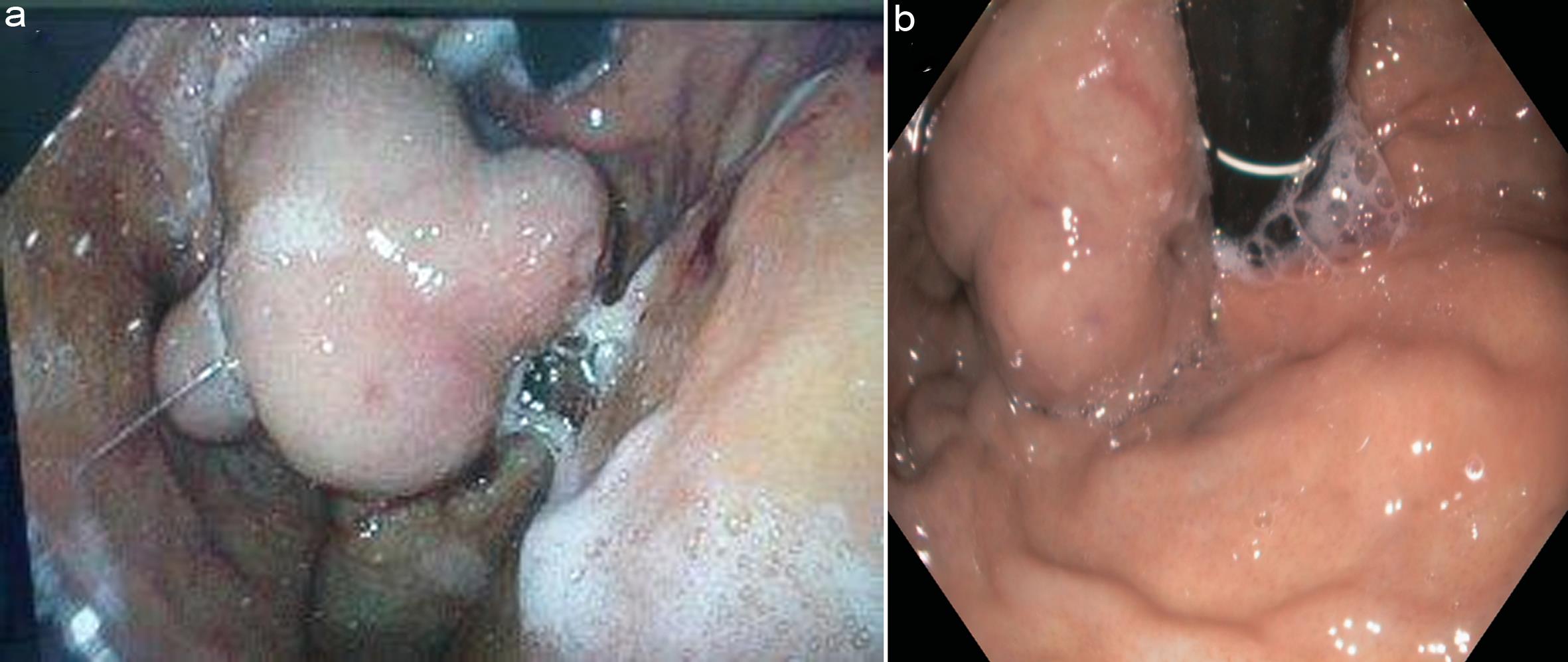 Original endoscopic images of gastric varices from case 1 (a) and 2 (b).
