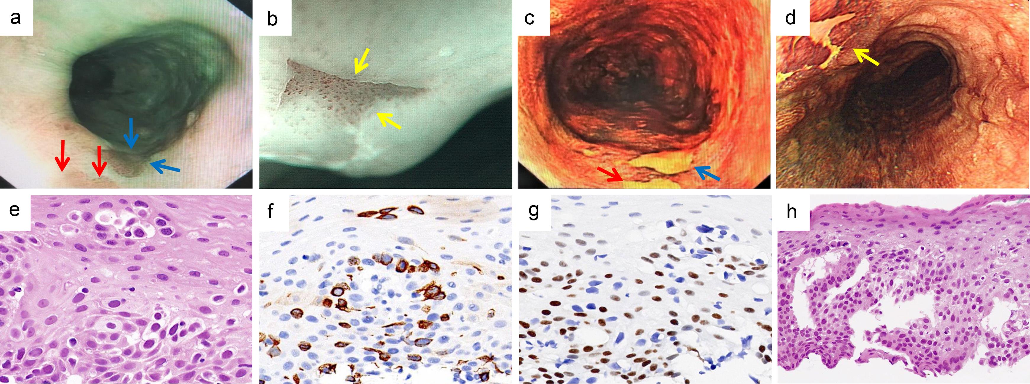 Endoscopic and pathological findings of the esophagus.