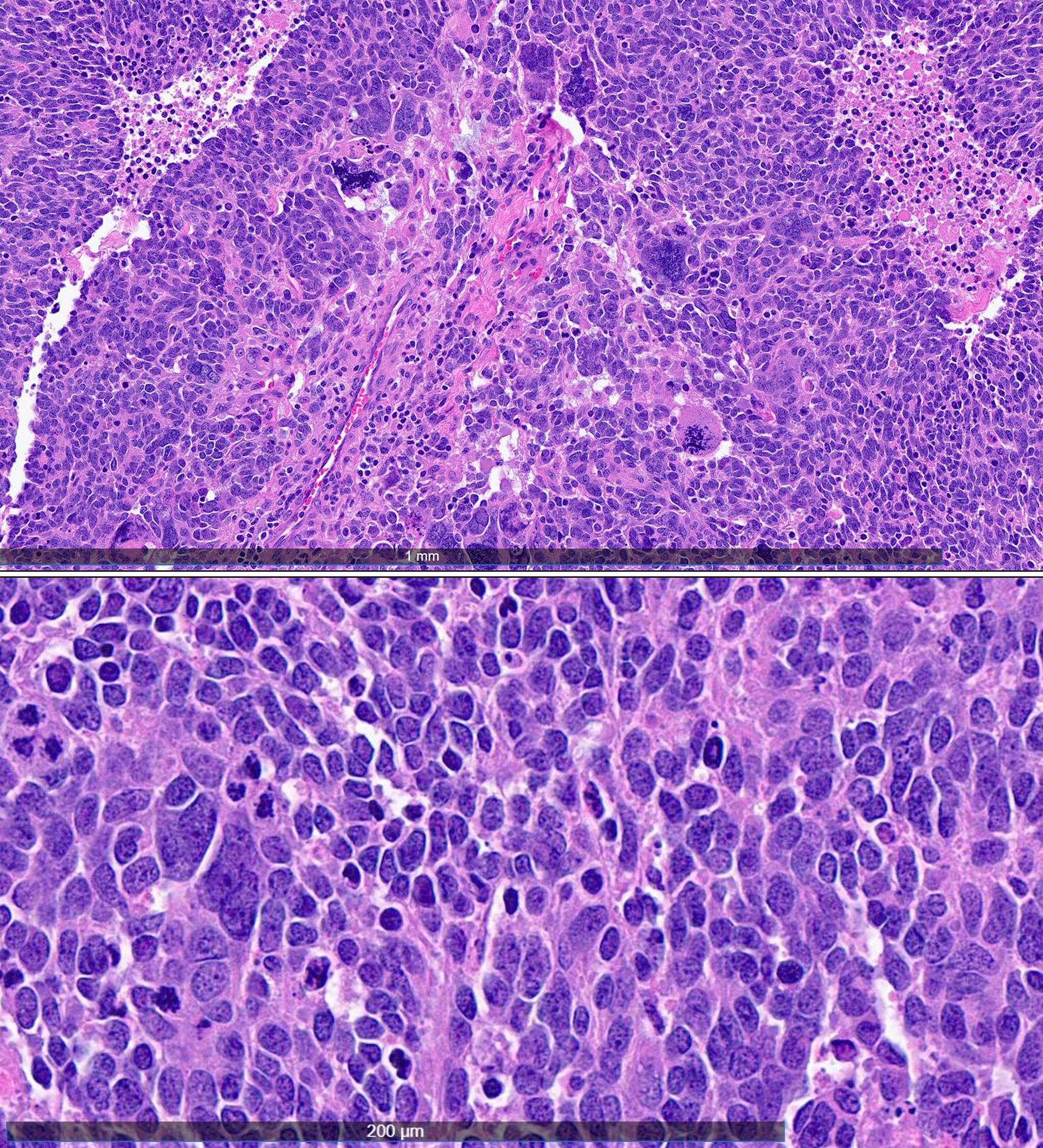H&E-stained sections (40× and 200× magnification, respectively) demonstrate solid sheets of tumor cells characterized by a high nuclear-to-cytoplasmic ratio, marked nuclear pleomorphism, nuclear molding, frequent mitotic figures, and focal necrosis.