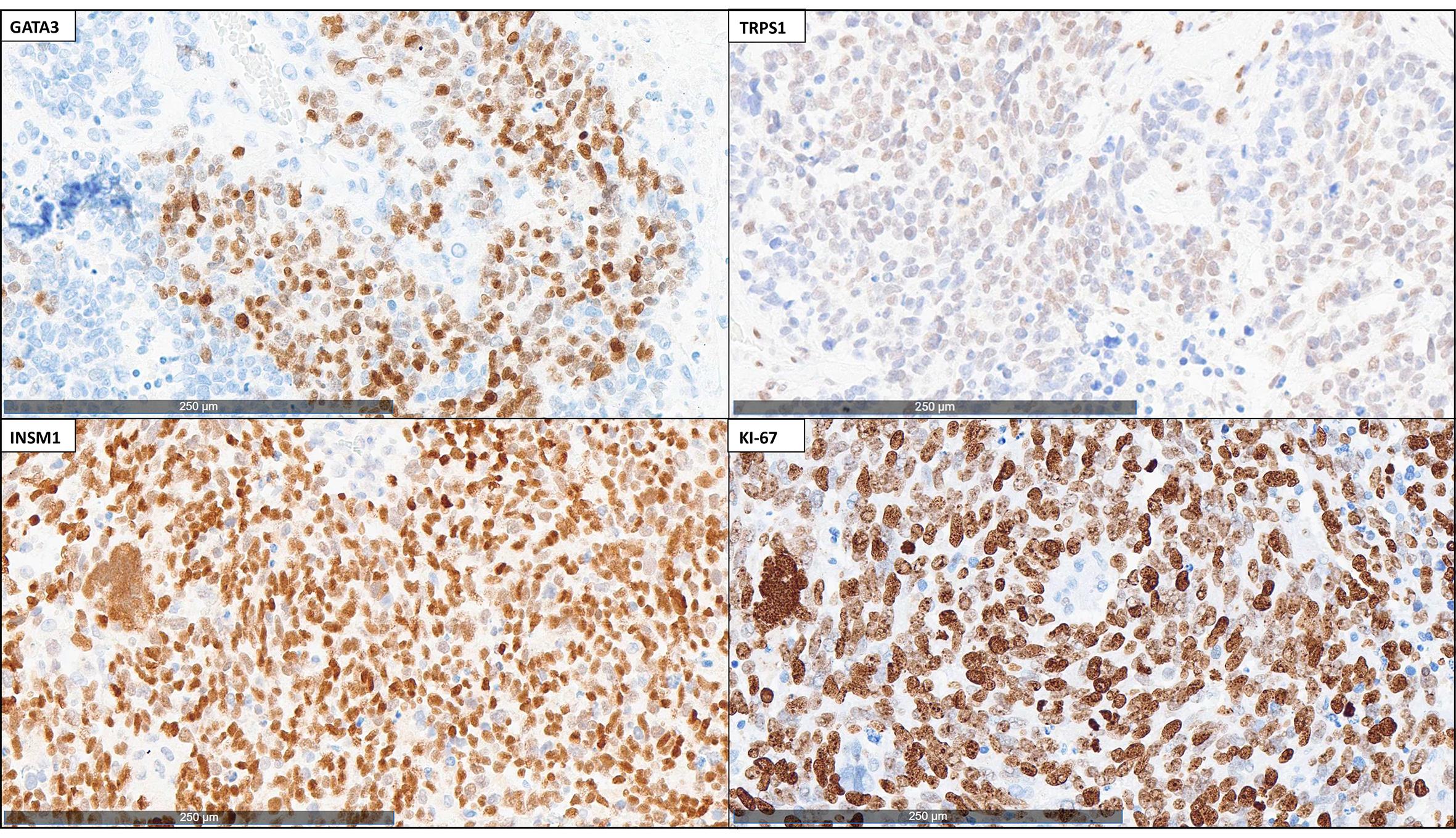The tumor cells from the resection specimen demonstrate focal expression of GATA3 and TRPS1 and diffuse expression of INSM1 (200× magnification).