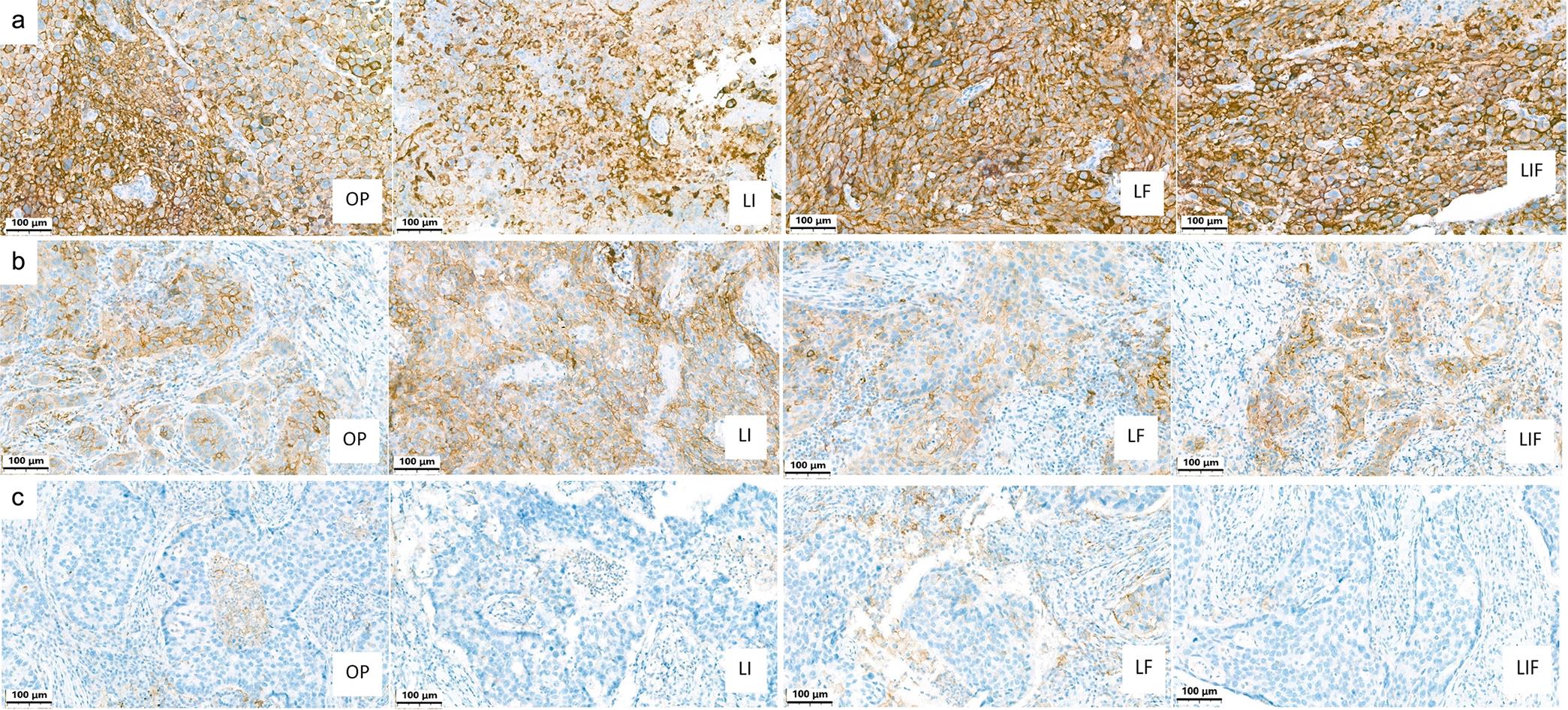 PD-L1 results of three excisional tumor samples processed with <1-h ischemia and fixation time between 12 and 48 h (optimal processing – OP); 12 h of ischemia and 12 to 48 h fixation (upper-limit ischemia – LI); ischemia < 1 h and fixation for 72 h (upper-limit fixation – LF); and 12 h ischemia and 72 h fixation (upper-limit for ischemia and fixation – LIF).