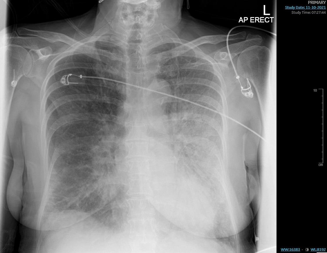 Chest X-ray showing acute pulmonary edema.