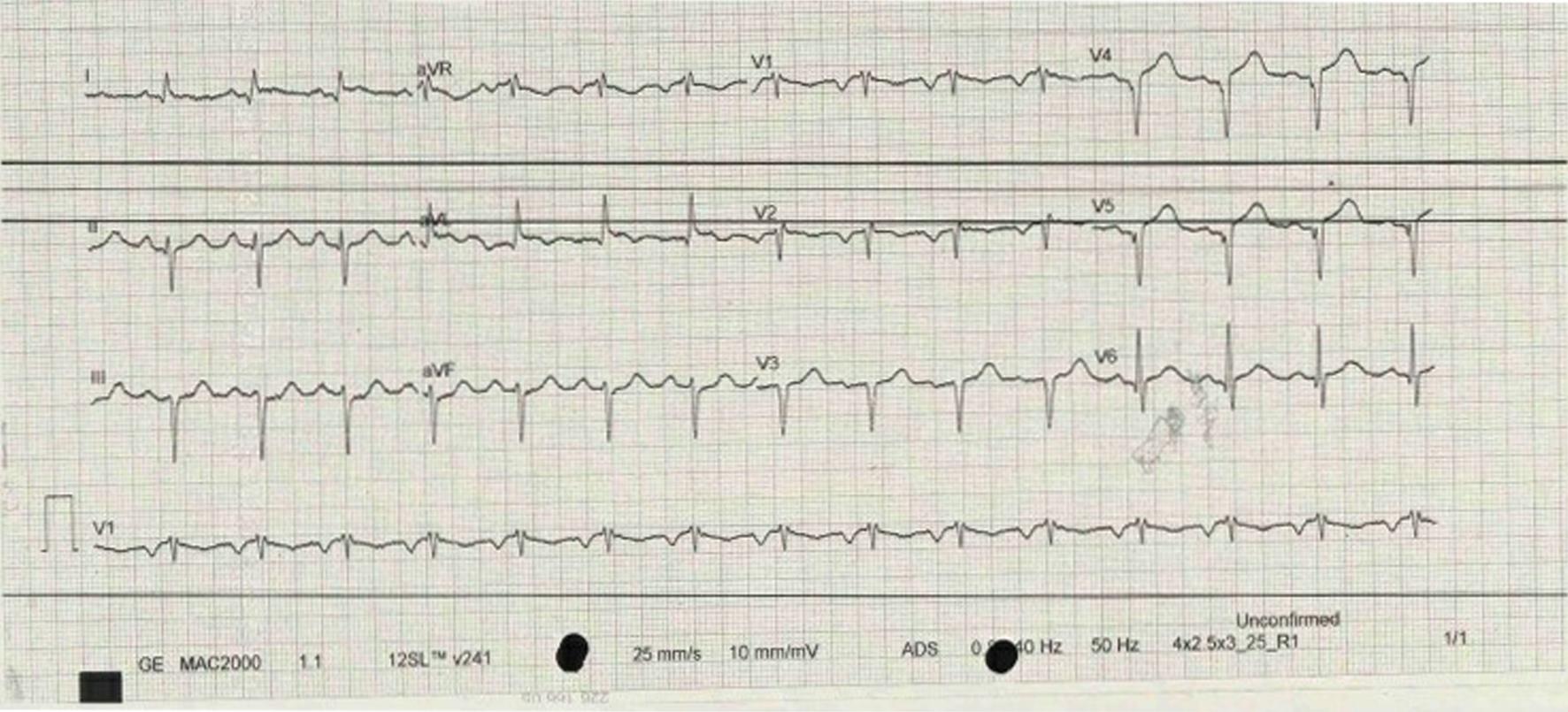 Electrocardiogram changes consistent with anterior STEMI, Q waves in V1 to V5, III and aVF, and ST elevation in V4 and V5.